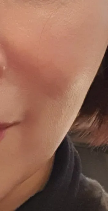 시술 후 — 미케이 민트실 동안 리프팅_팔자,눈가