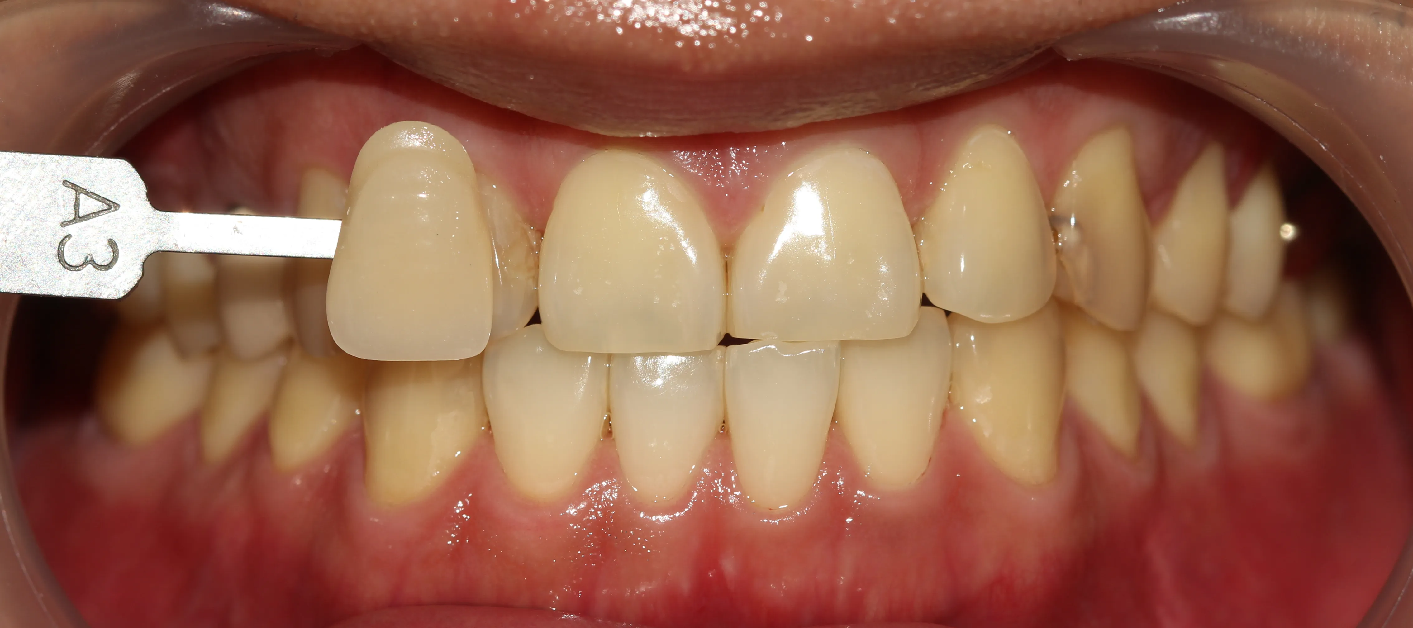 Before treatment — Teeth whitening, really! ♥ 39,000 won ♥