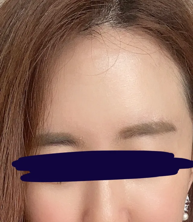 시술 후 — 싸이토케어 (에르메스주사)