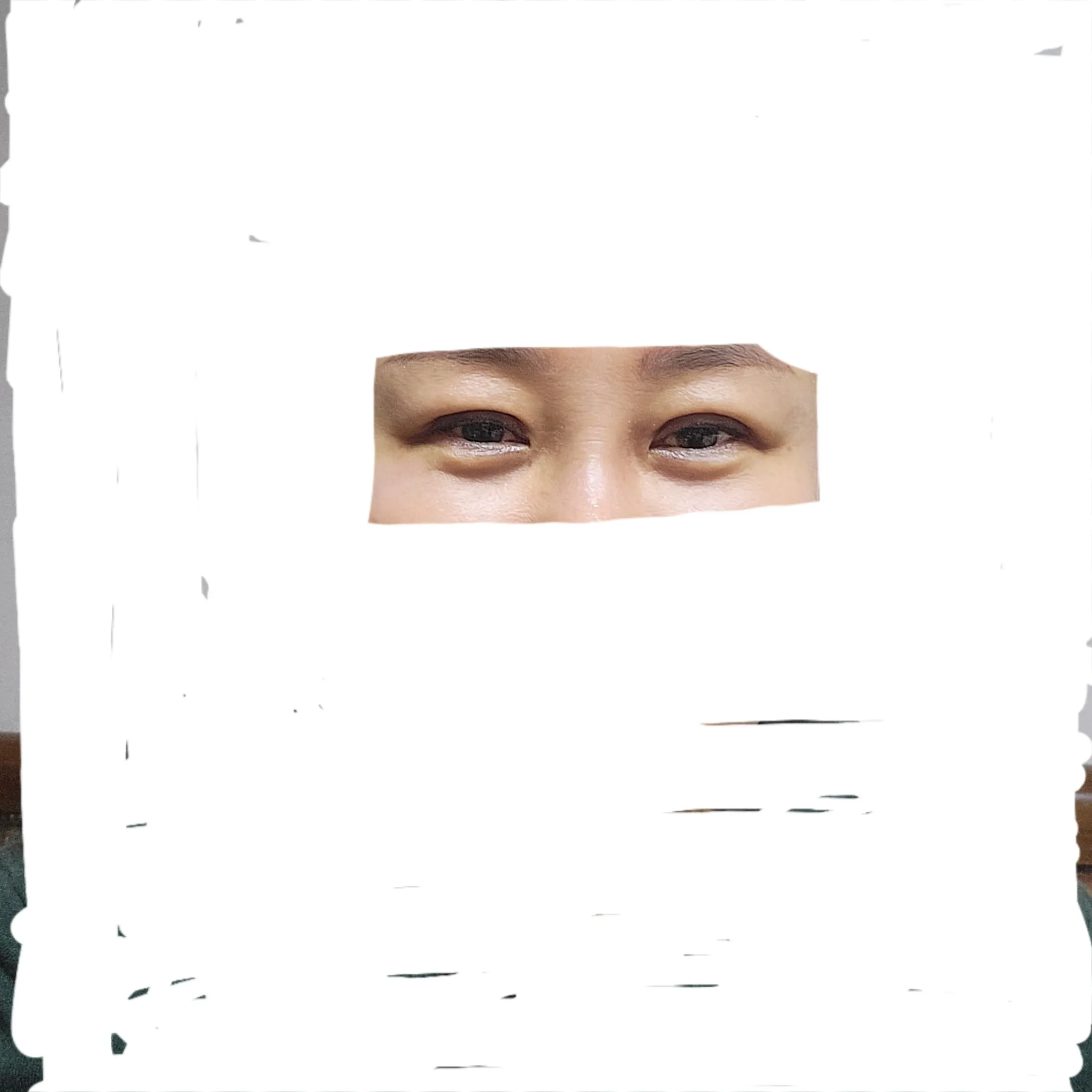 시술 후 — 디데이💖비절개눈매교정