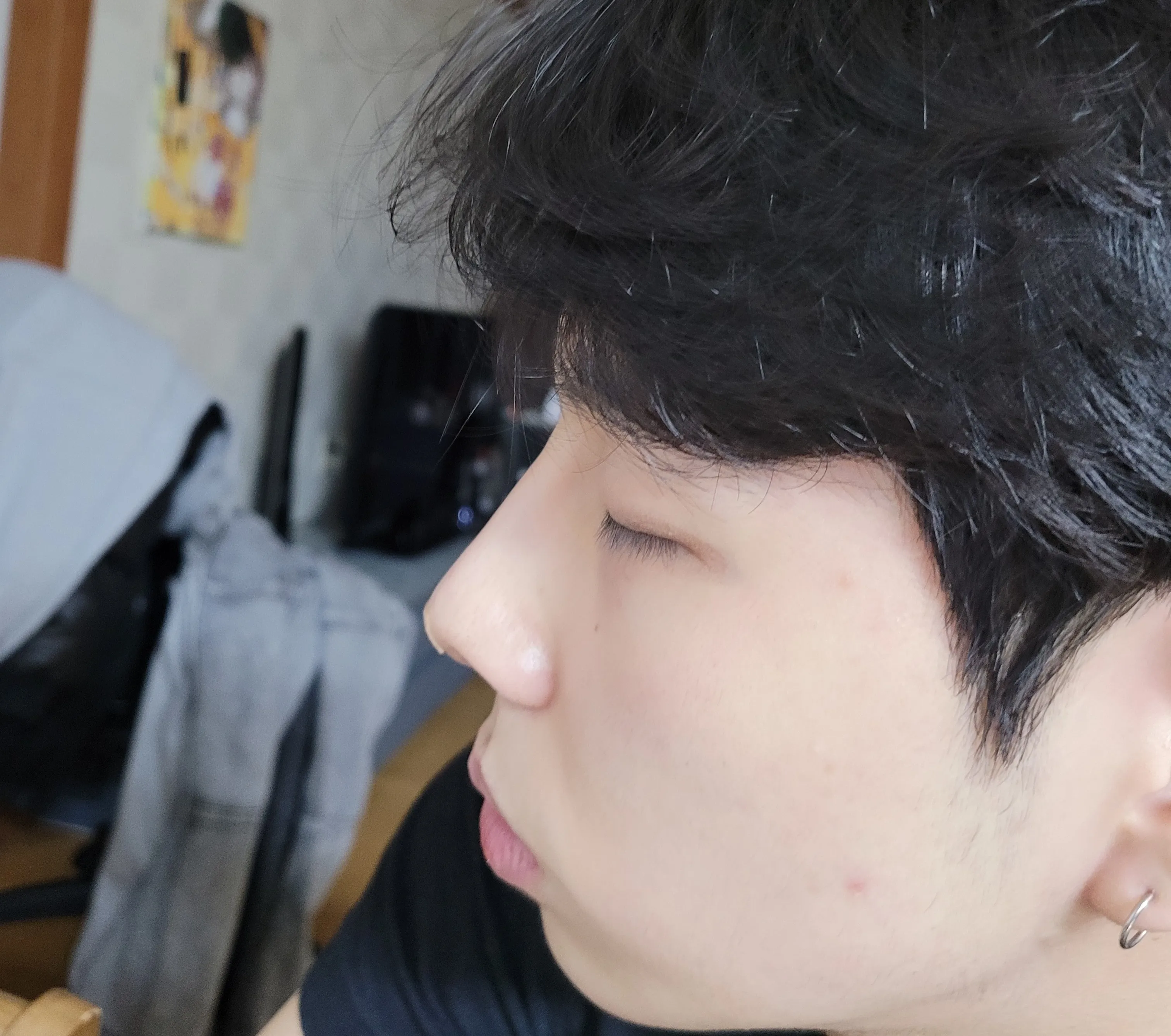 시술 후 — 강남 쁘띠장인 코필러 