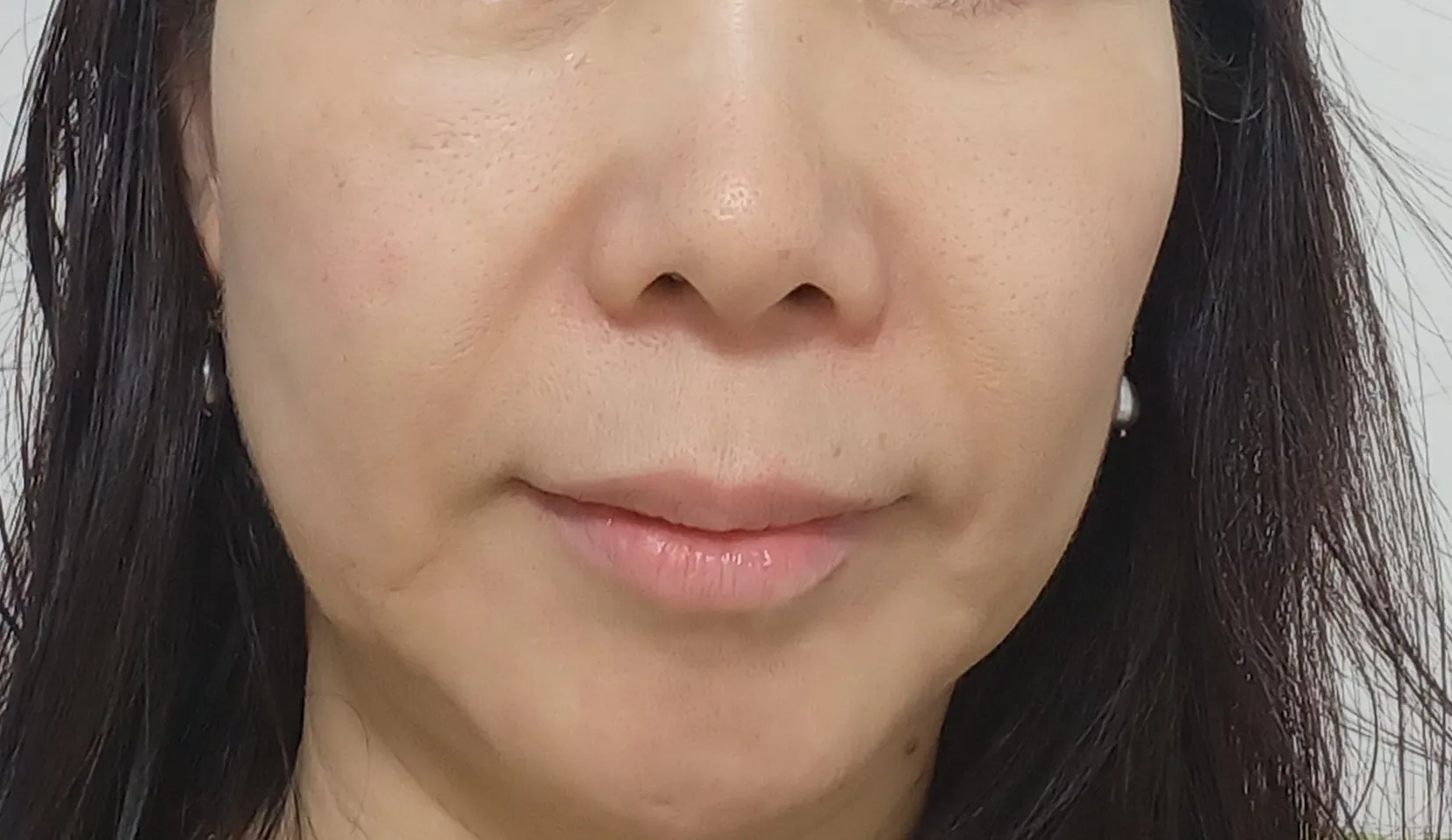 시술 전 — 미케이 피부 탄력개선_슈링크 300샷