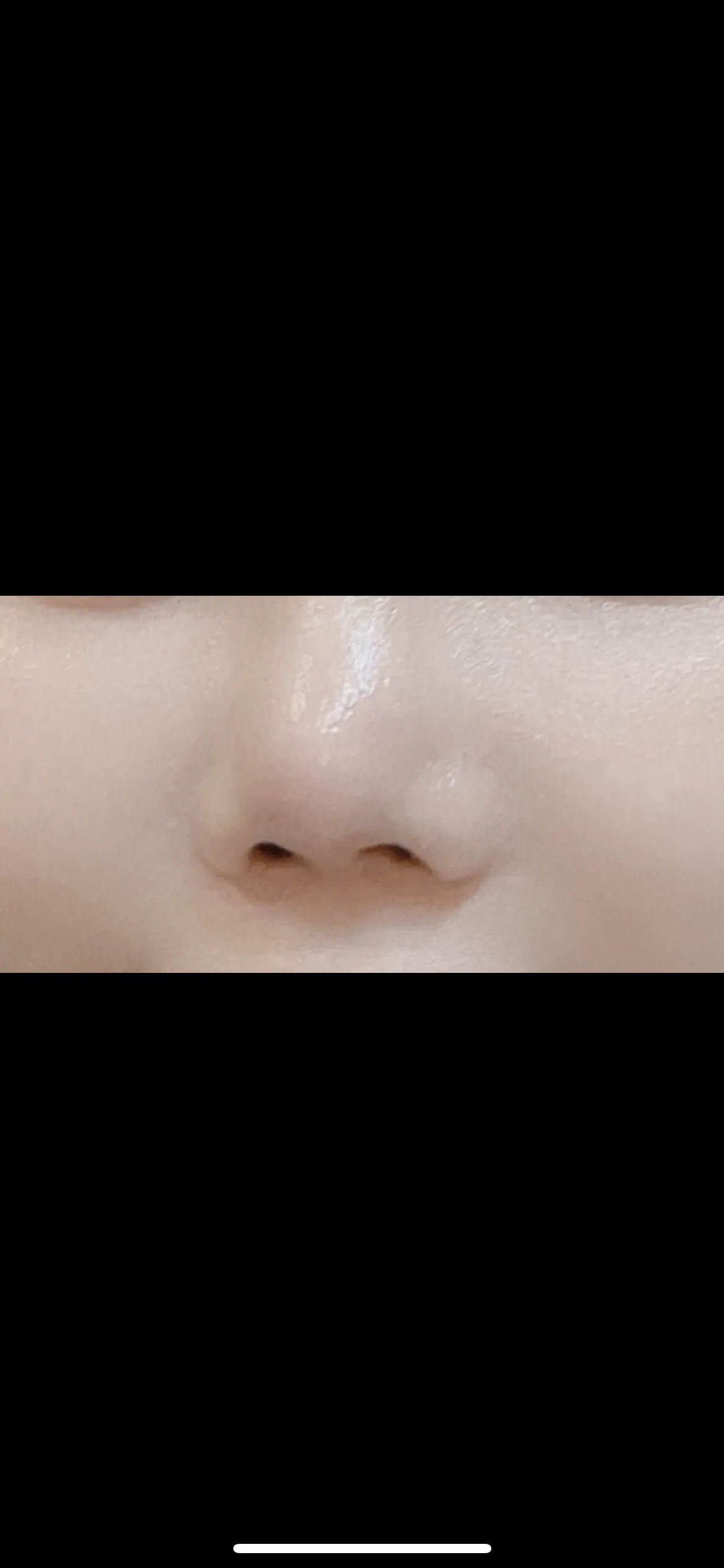 After treatment — ★ Rejuran Healer 7.9 ★ Pore Reduction, Skin