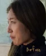 시술 전 — 말랑말랑 무보형물 코성형