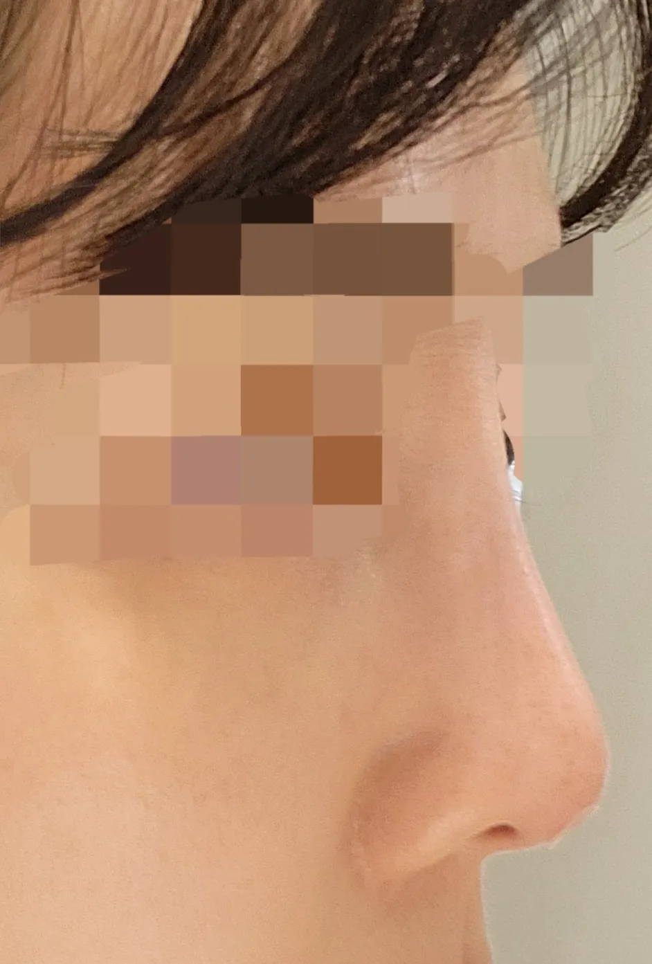 시술 후 — 코필러 하이코 대신  레이디코