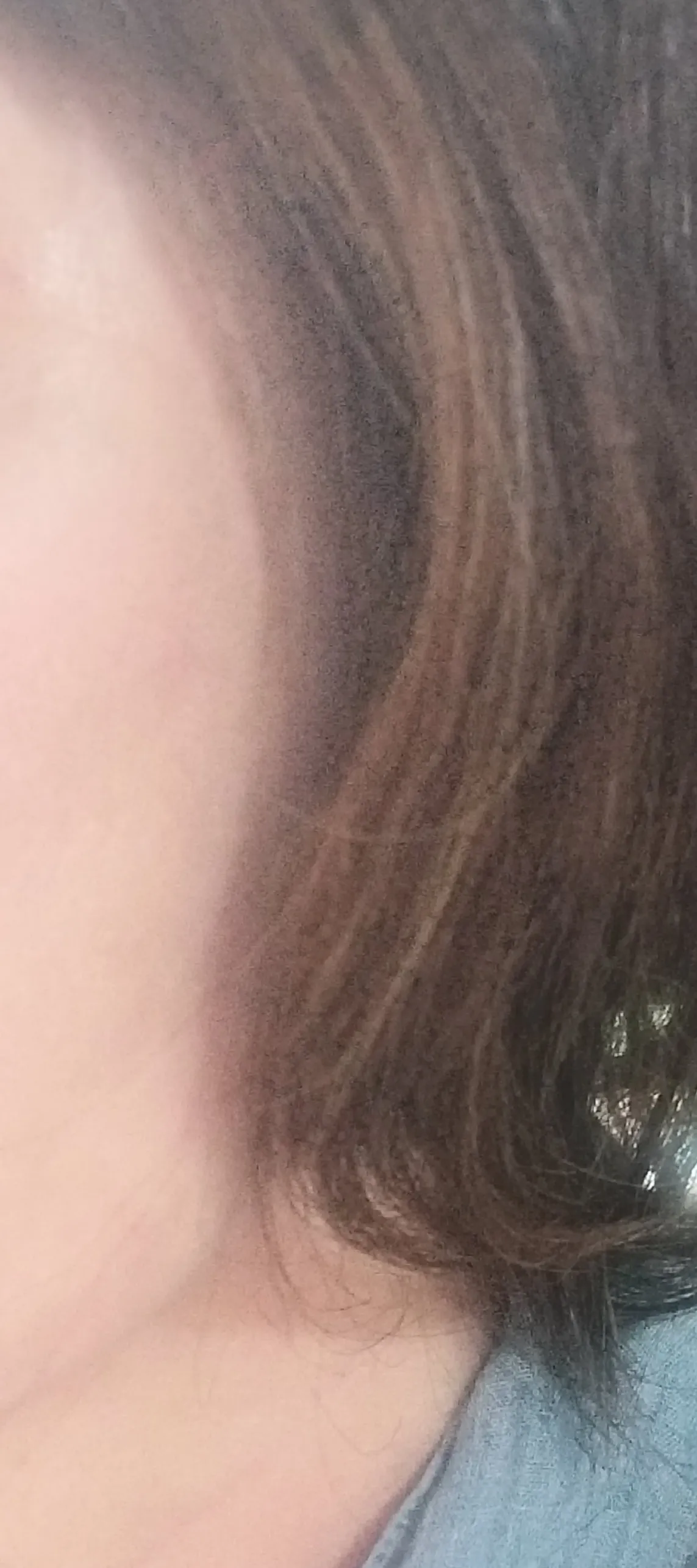After treatment — Skin Regeneration #Skin Elasticity #For Fine Lines: Rejuran Healer