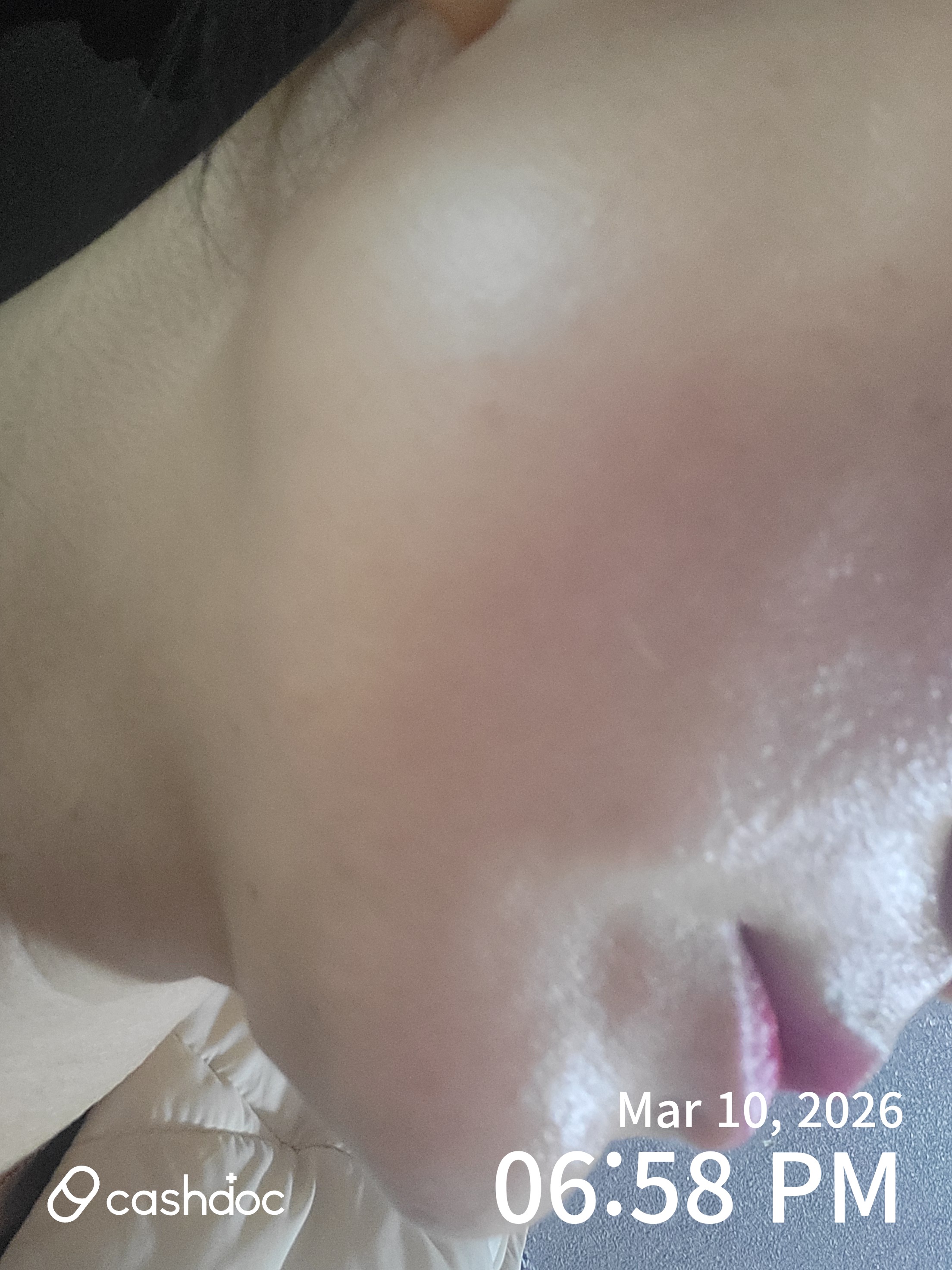 안양시 톡스앤필의원에서 받은 사각턱 보톡스 후기