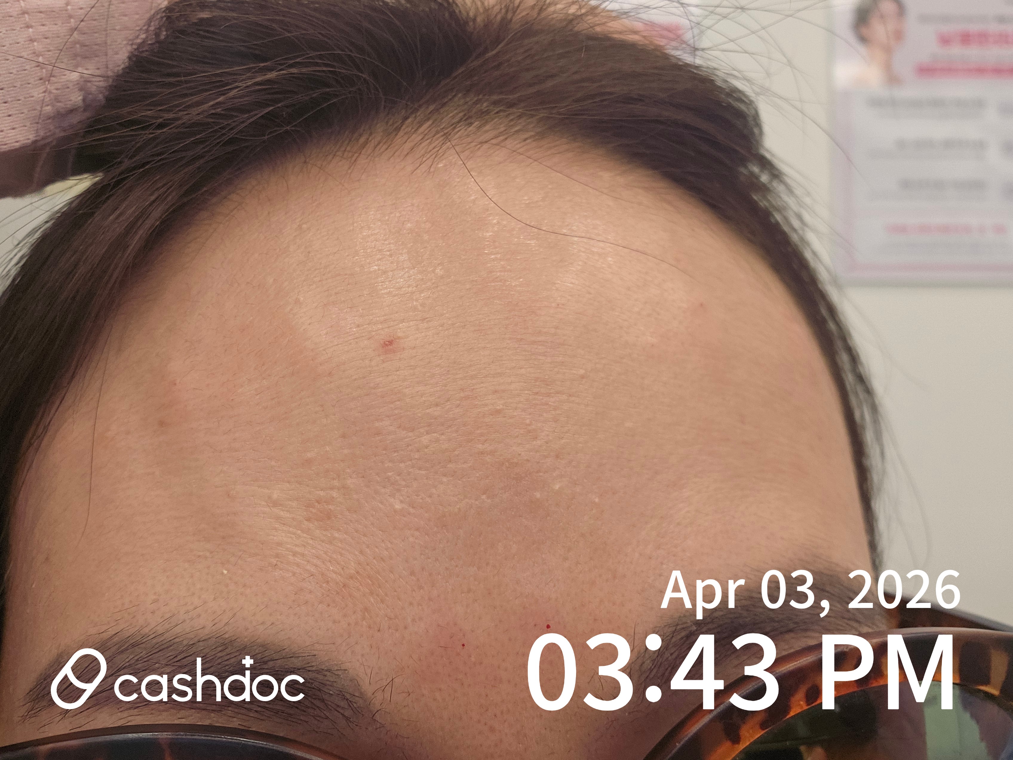 용인시 메이퓨어의원에서 보톡스로 주름 관리 후기!