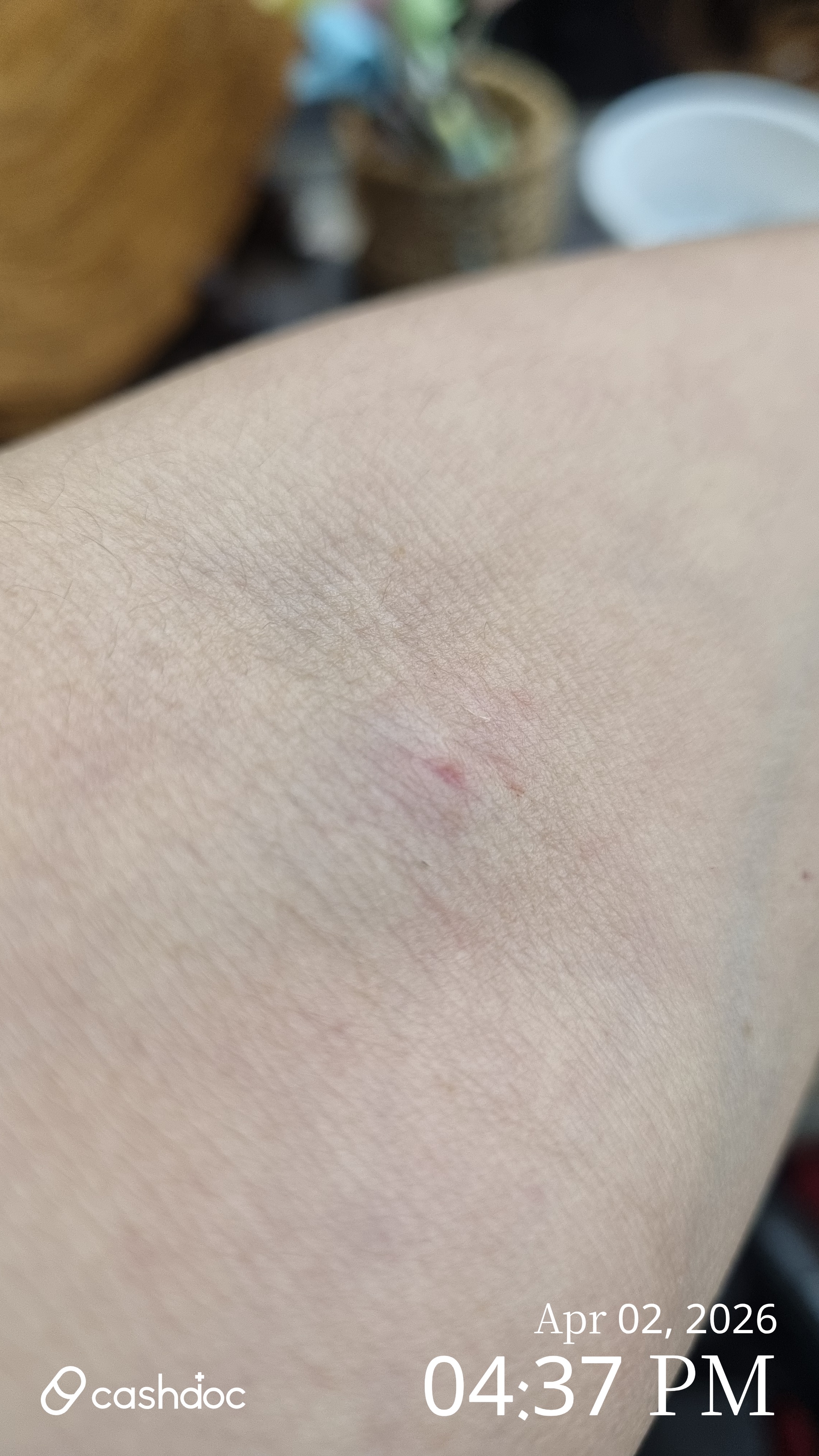 서구 서울예사랑내과에서 무사히 피검사 마쳤어요!