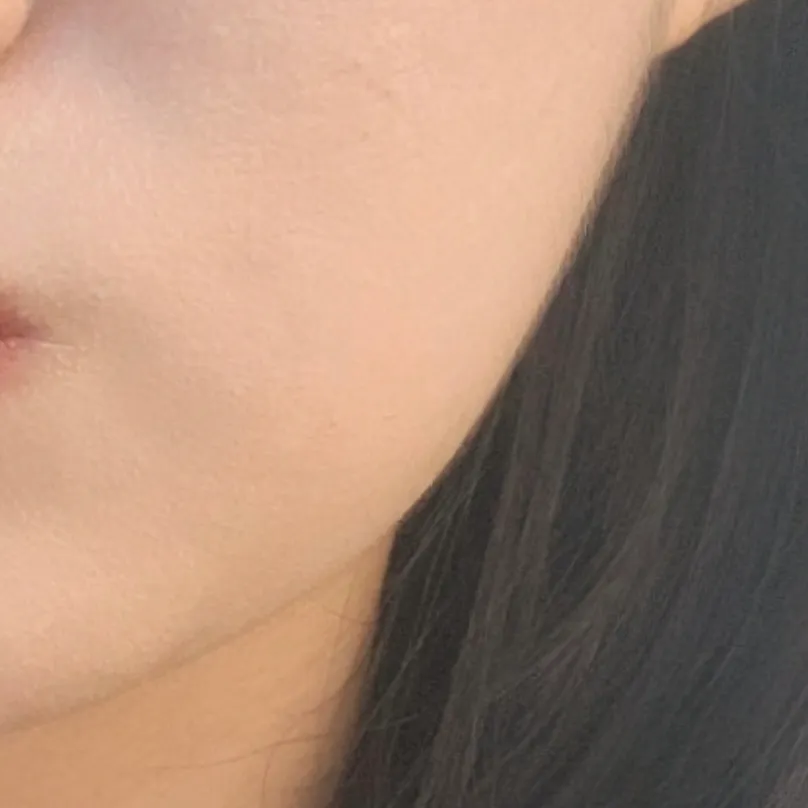 시술 전 — 인모드 얼굴전체 리프팅