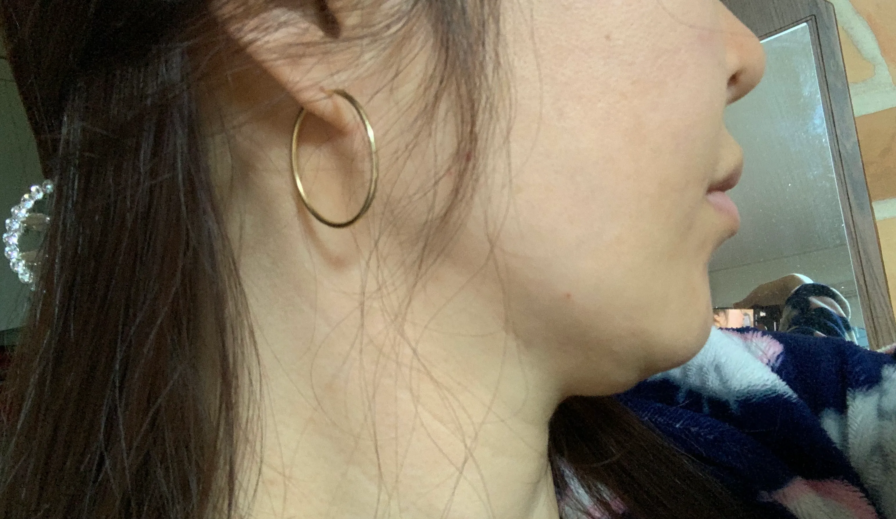 시술 전 — 강남점_주름 보톡스 4,900원