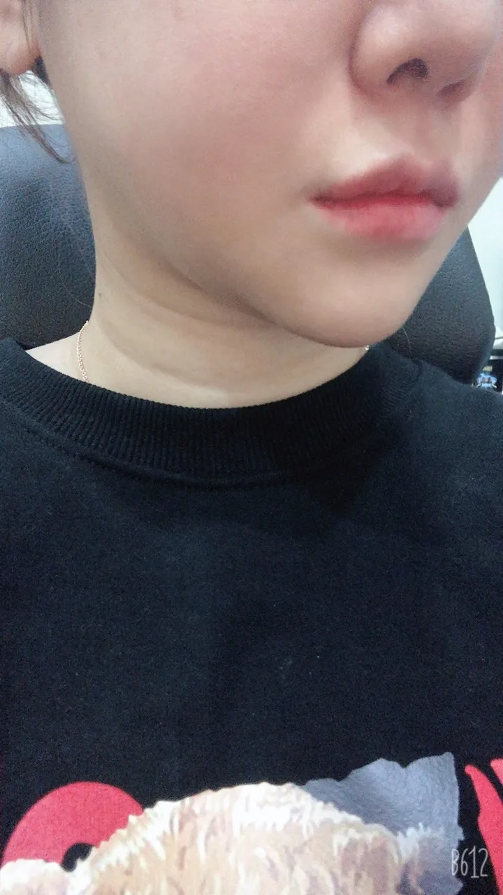 시술 후 — ★밴딩주사★ 이중턱제거