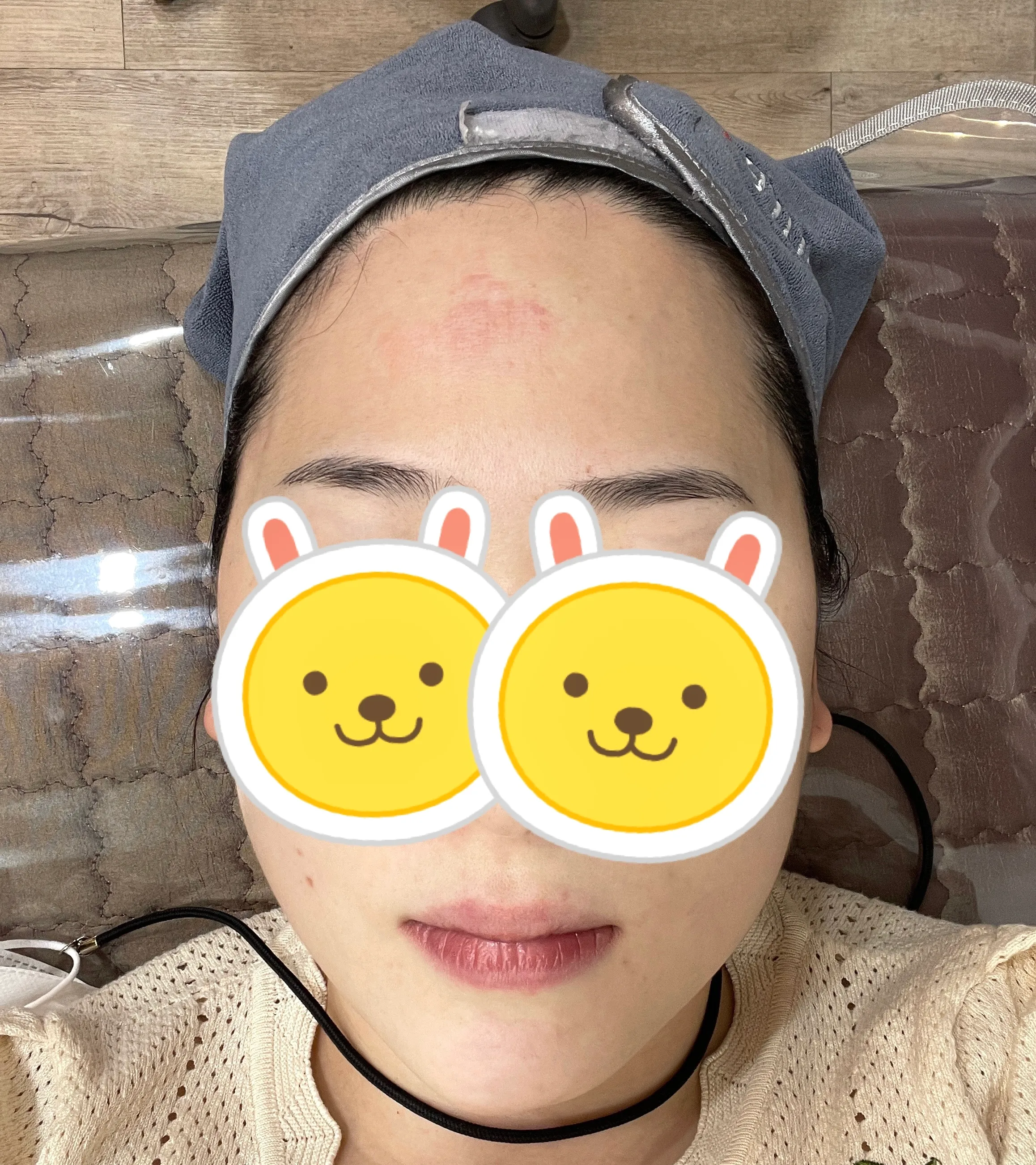 시술 후 — 기미/색소 완벽파괴! #대세 피코토닝