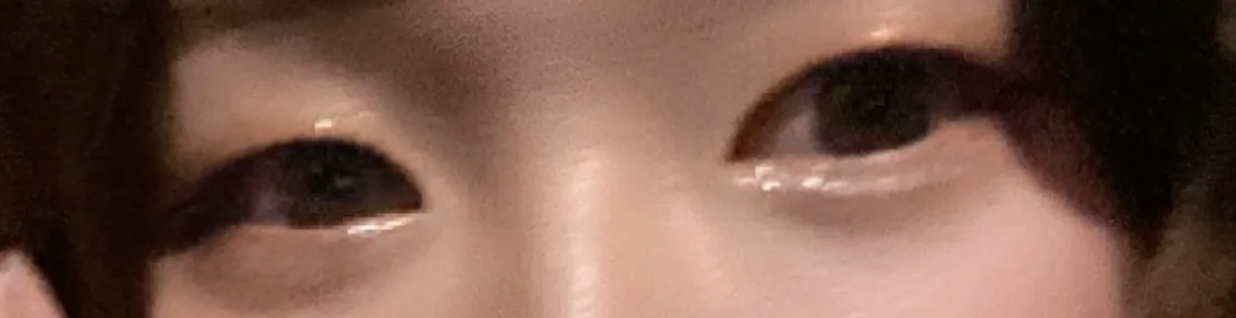 Before treatment — Lize Eye (Rejuran Eye + Eye Shrink) Package