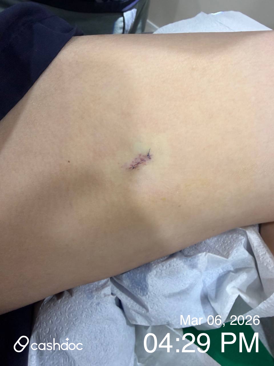 강남구 오체안성형외과의원에서 낭종 재수술, 결과에 만족해요