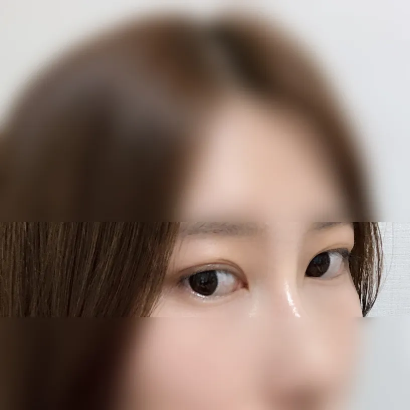 시술 전 — 눈매교정 