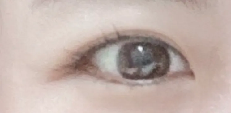 After treatment — Lize Eye (Rejuran Eye + Eye Shrink) Package