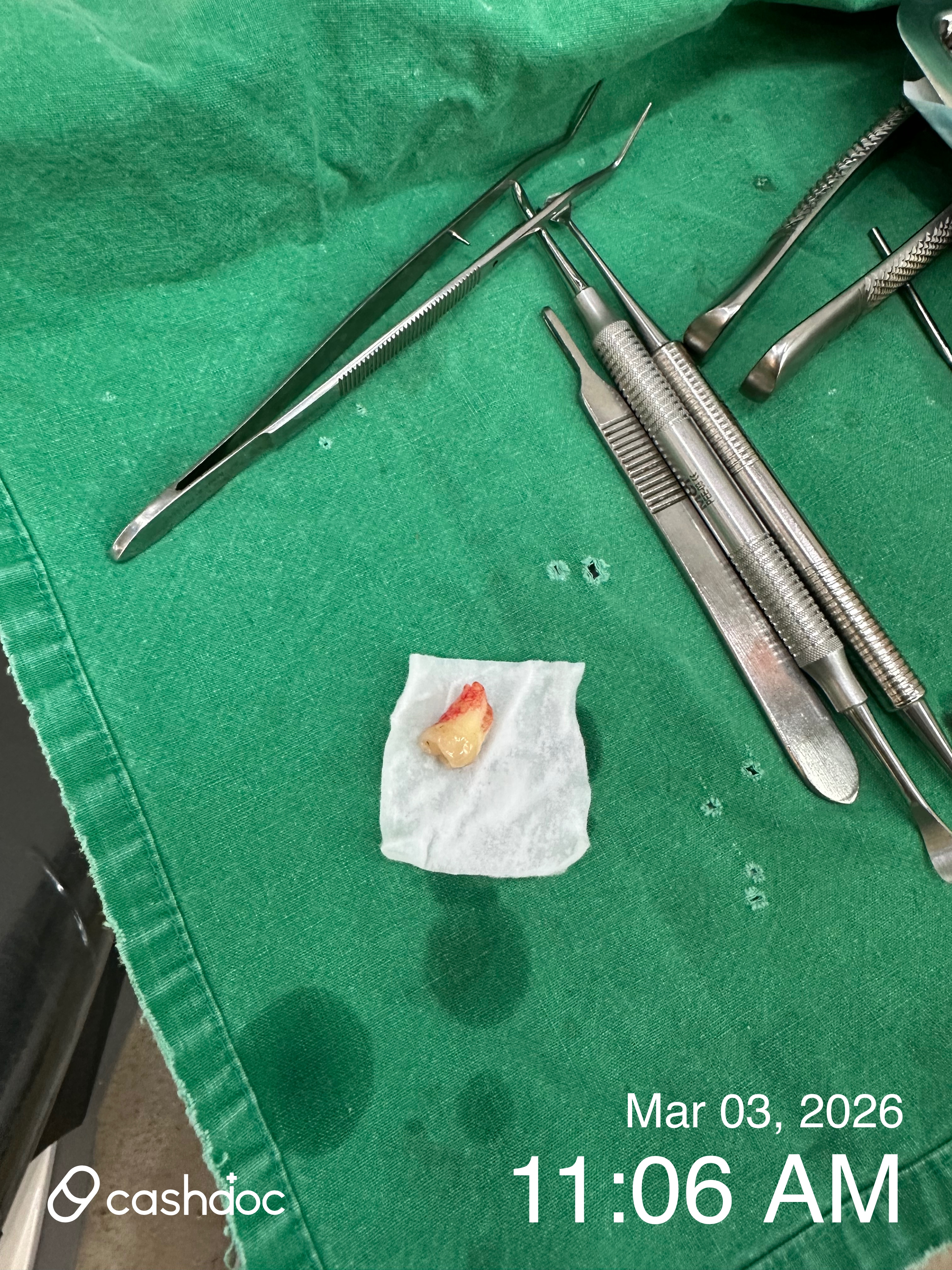 서대문구 잎사귀치과병원 사랑니 뽑기 경험, 친절은 부족해요