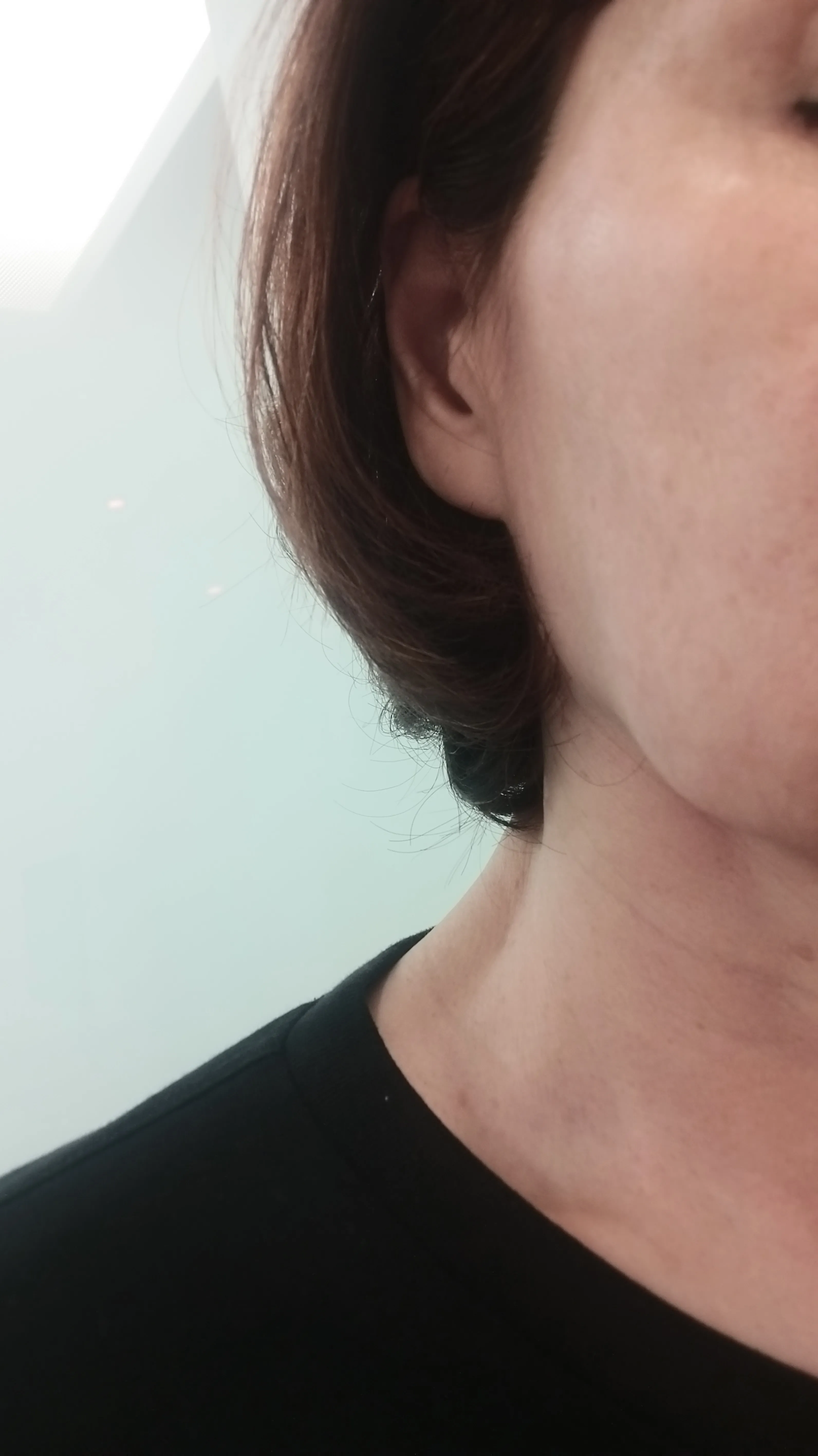 Before treatment — Skin Regeneration #Skin Elasticity #For Fine Lines: Rejuran Healer