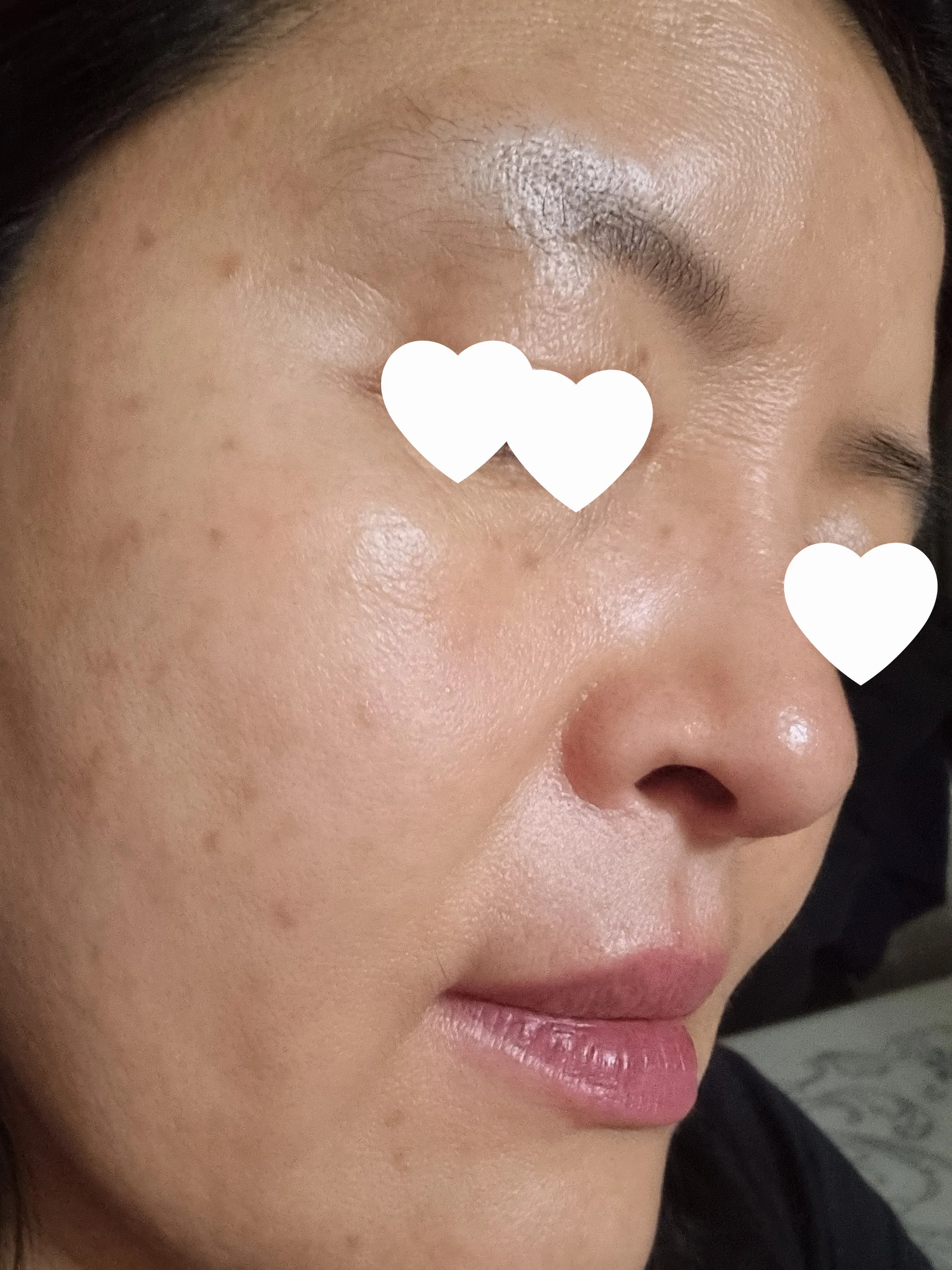 시술 전 — [잡티지우개]에이톤레이저