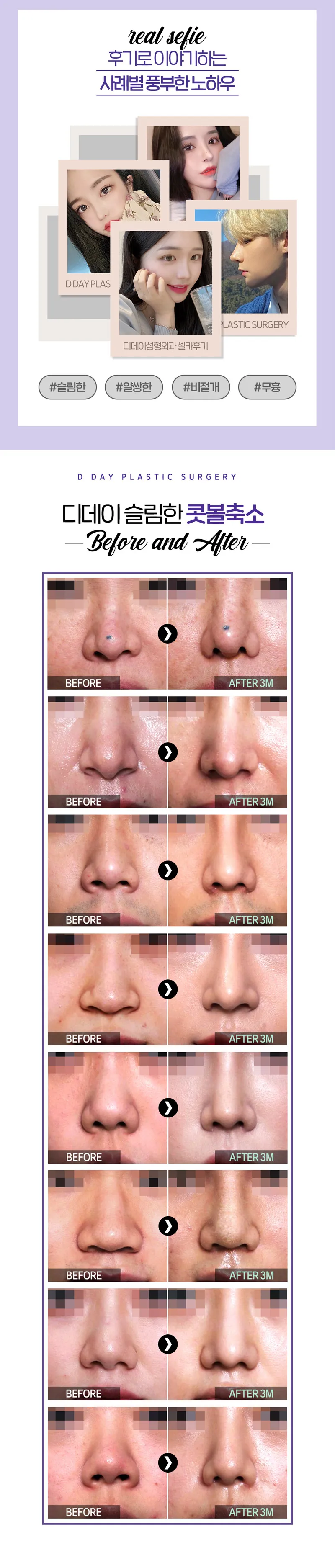 디데이성형외과의원 디데이 슬림한 콧볼축소 55 이벤트, 시술 상세 이미지