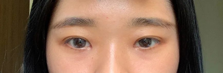 시술 후 — 오썸 자연유착
