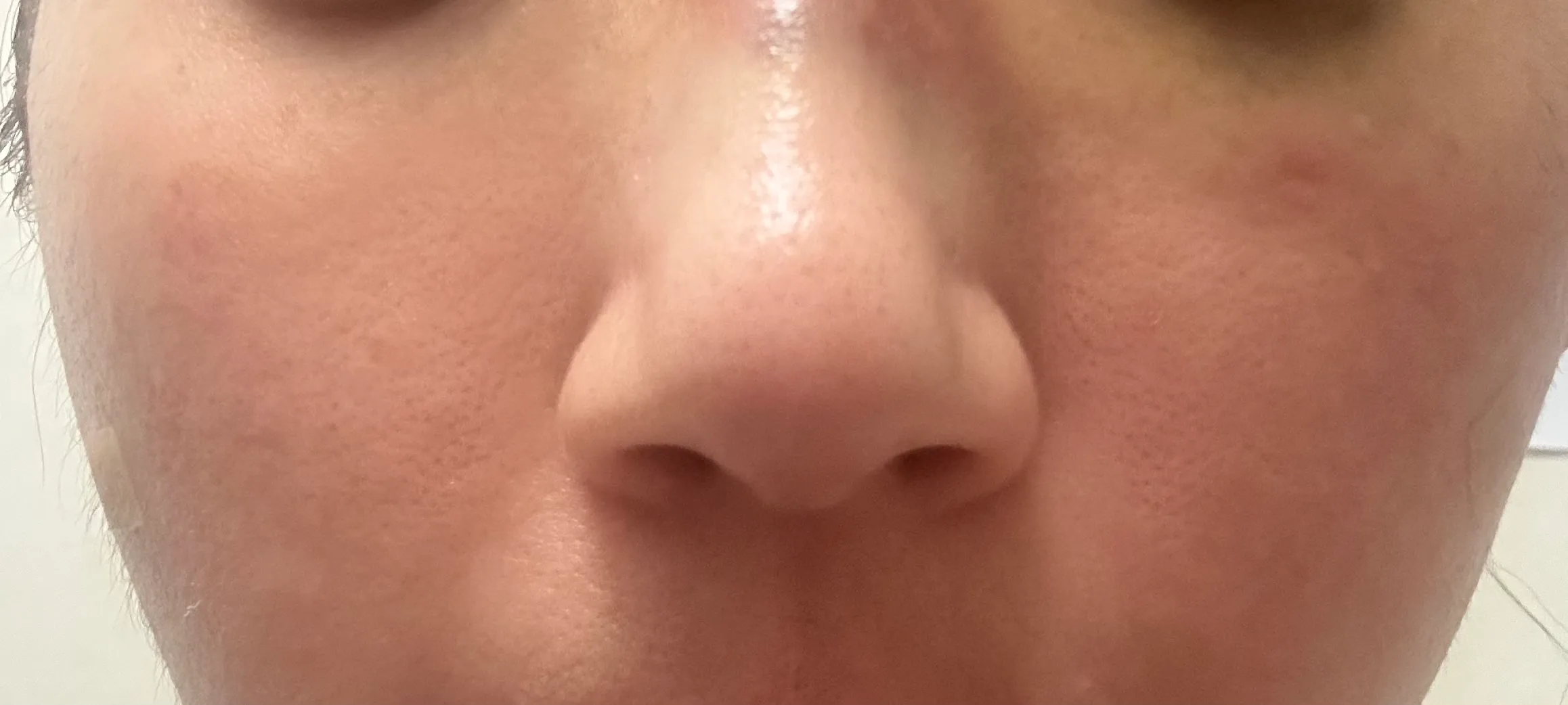 After treatment — Skin Regeneration #Skin Elasticity #For Fine Lines: Rejuran Healer