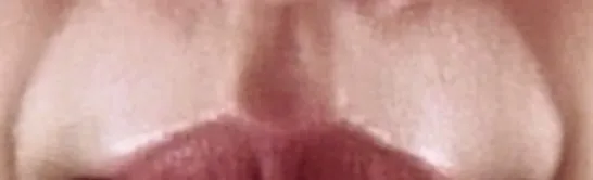 시술 전 — 팔자필러