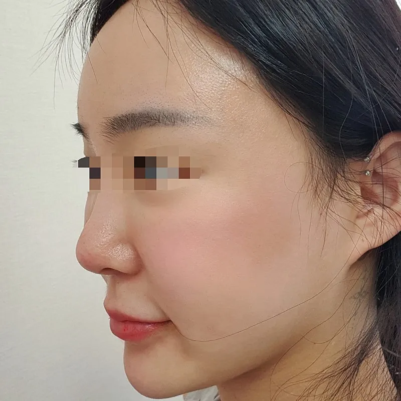 Before treatment — Pain Reduction - Special Offer on #RejuranHealer