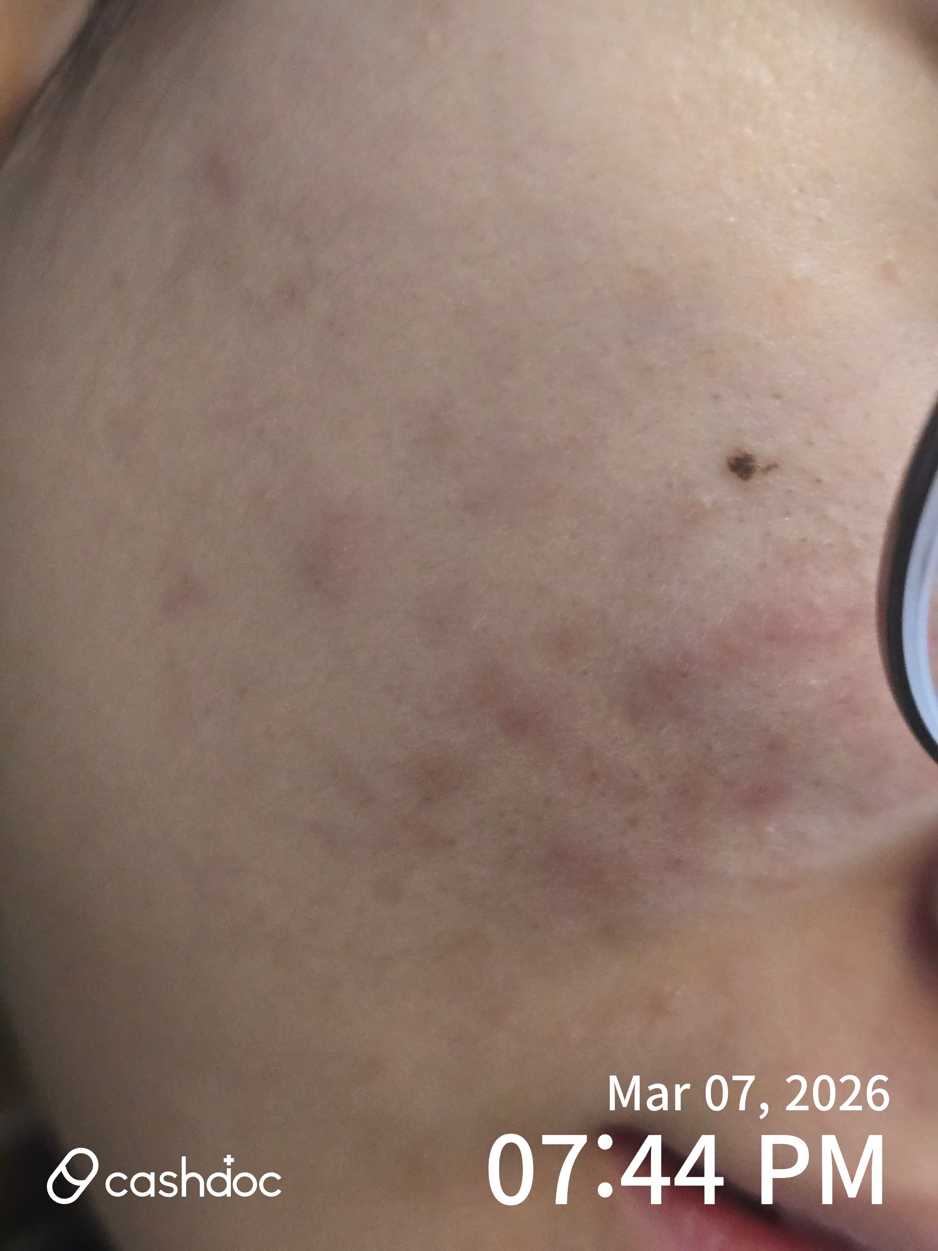 시흥배곧 서울뷰의원, 딸 아이 여드름 치료 후기