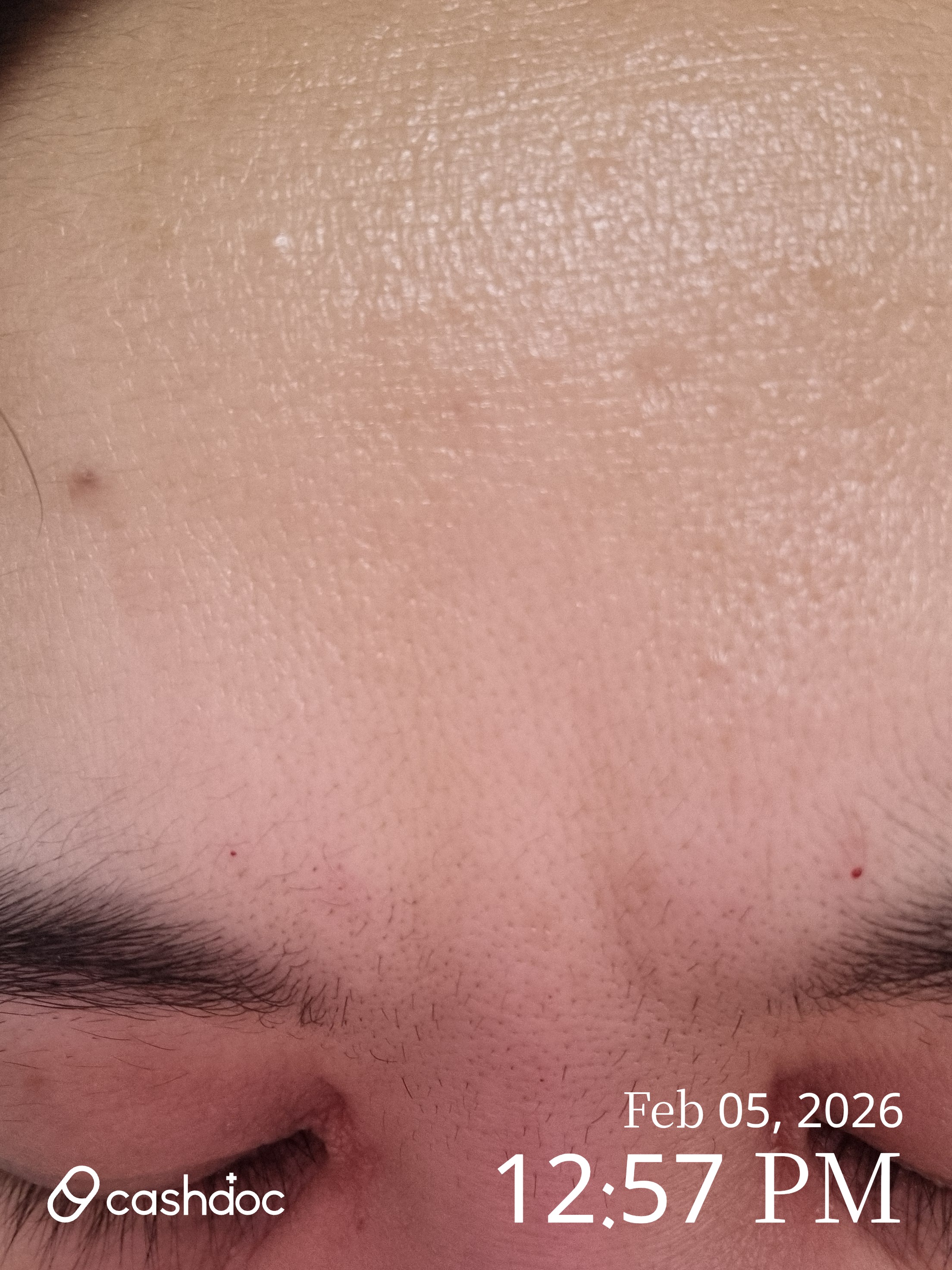 광진구 메이퓨어 구의역점에서 빠르고 개운한 보톡스 경험