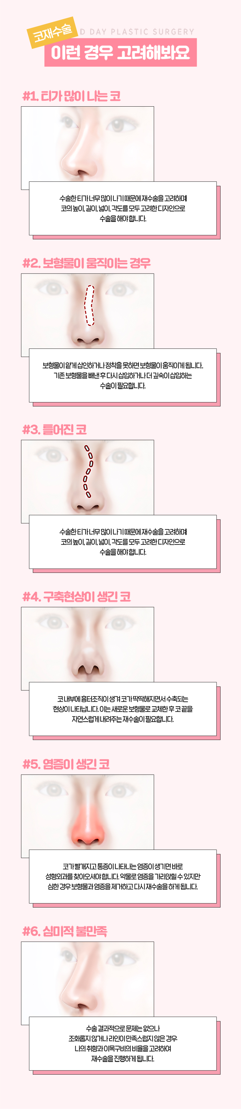 디데이성형외과의원 💖디데이 코재수술💖 이벤트, 시술 상세 이미지