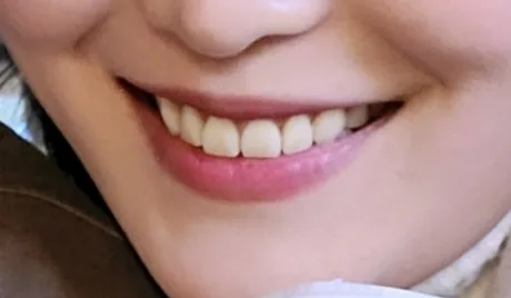Before treatment — Teeth Whitening in 30 Minutes