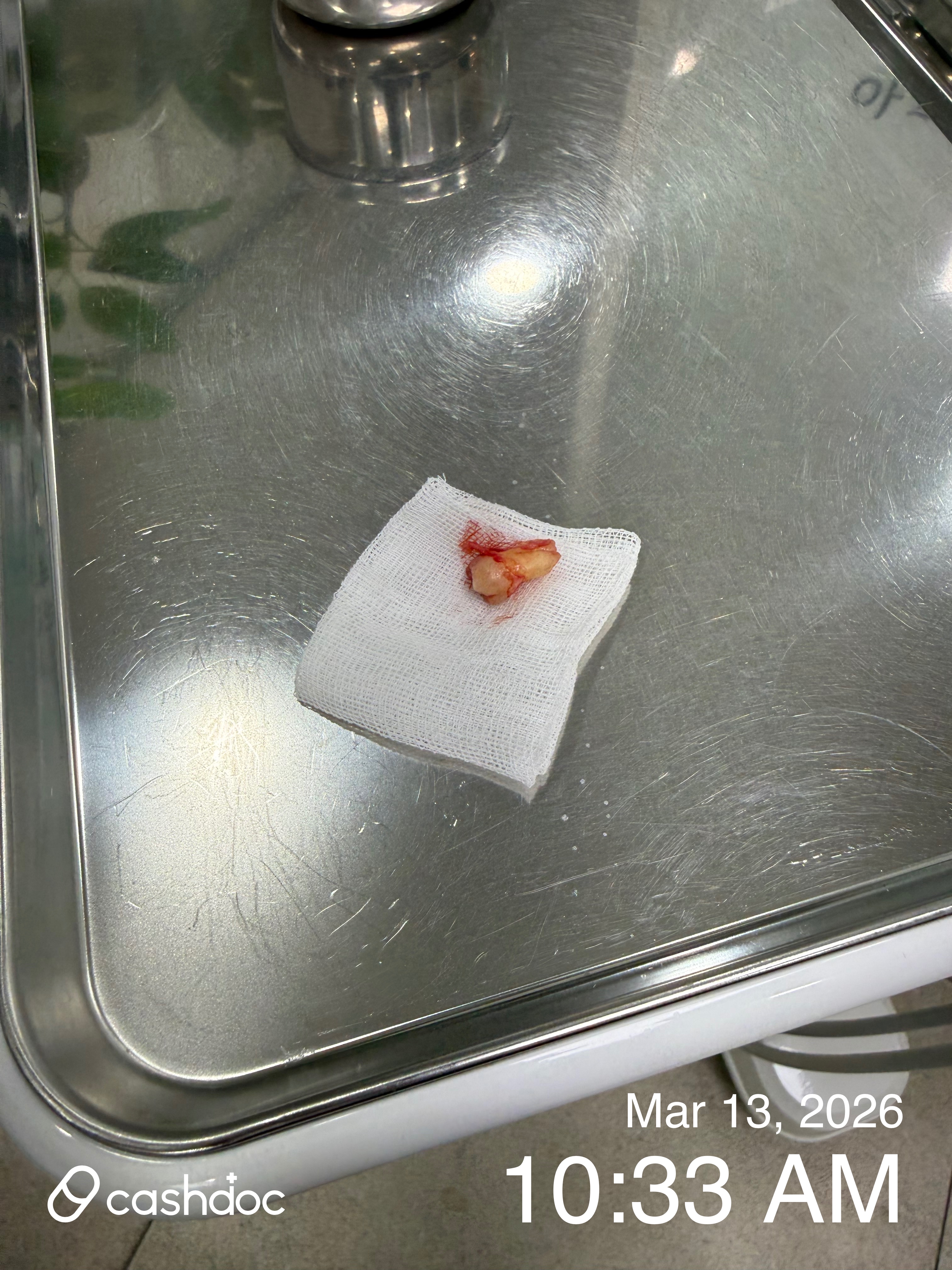 안양시 턱편한사랑니치과에서 시원하게 사랑니 발치해요