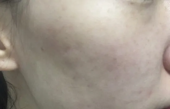 Before treatment — Pain reduction - Special offer on #Rejuran Healer