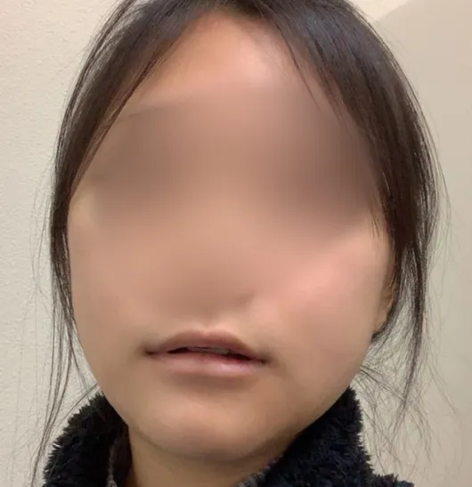 After treatment — Wonjin_Facial Contouring