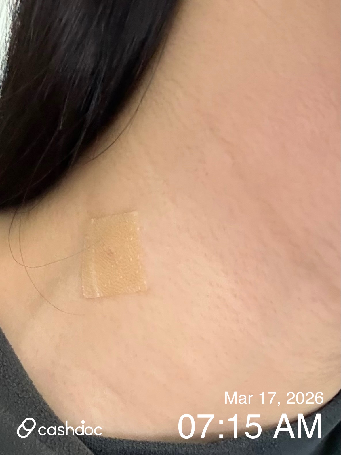 성남시 메이퓨어 미금점에서 CO2레이저 시술 후기