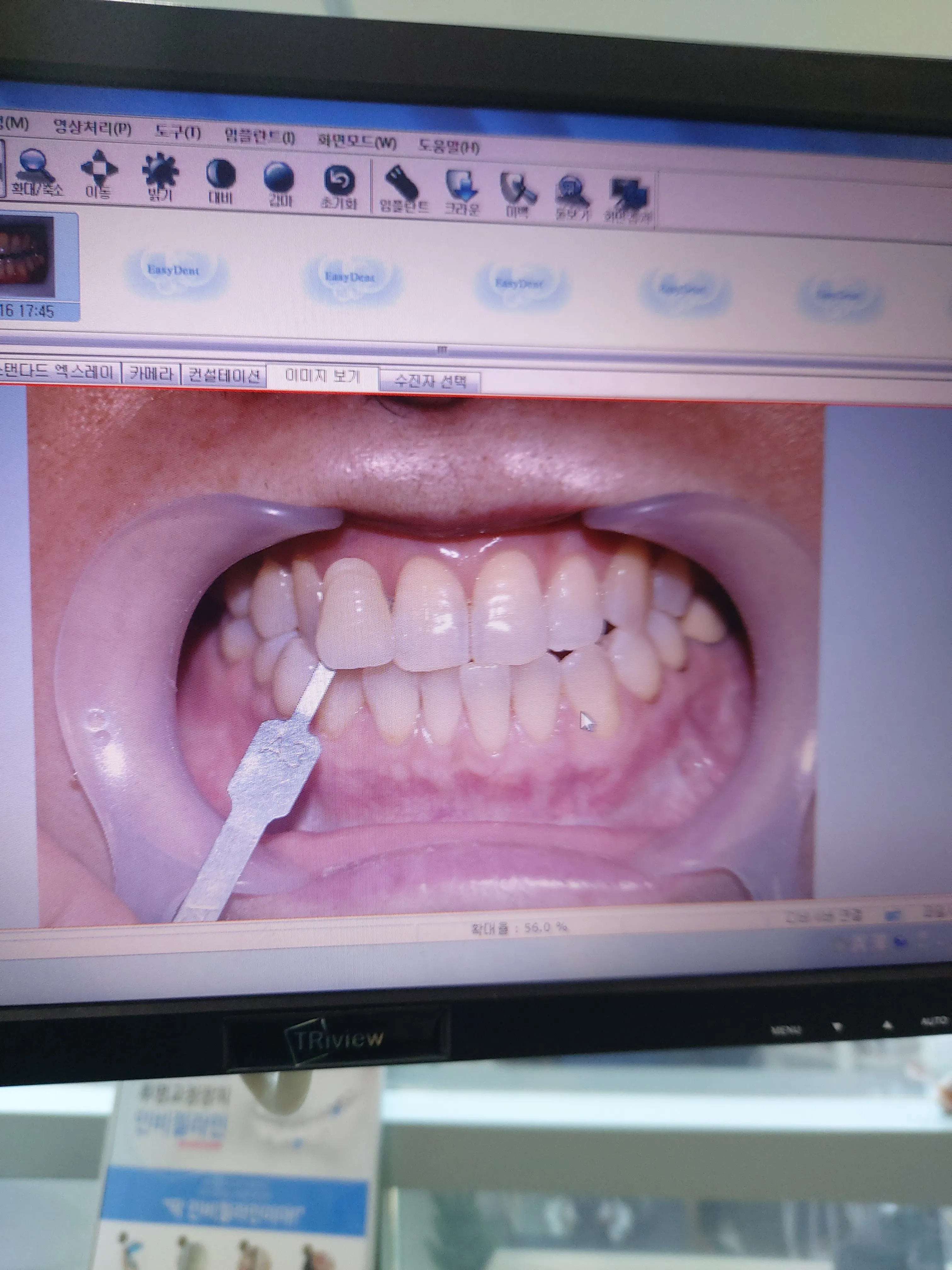 Before treatment — Teeth whitening, really! ♥ 39,000 won ♥