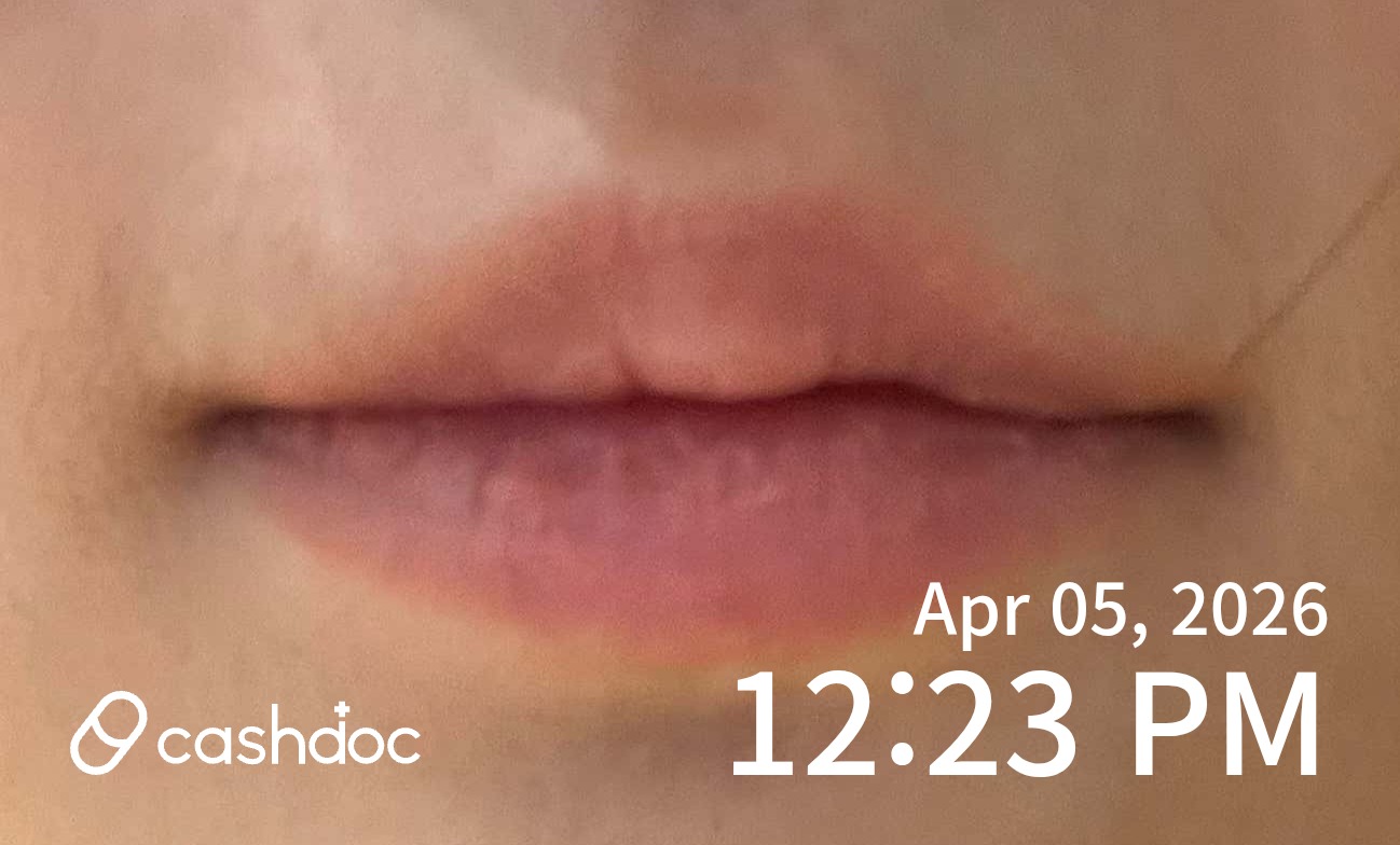 서초구 나비성형외과의원, 입술필러 빠르고 자연스럽게 잘해요