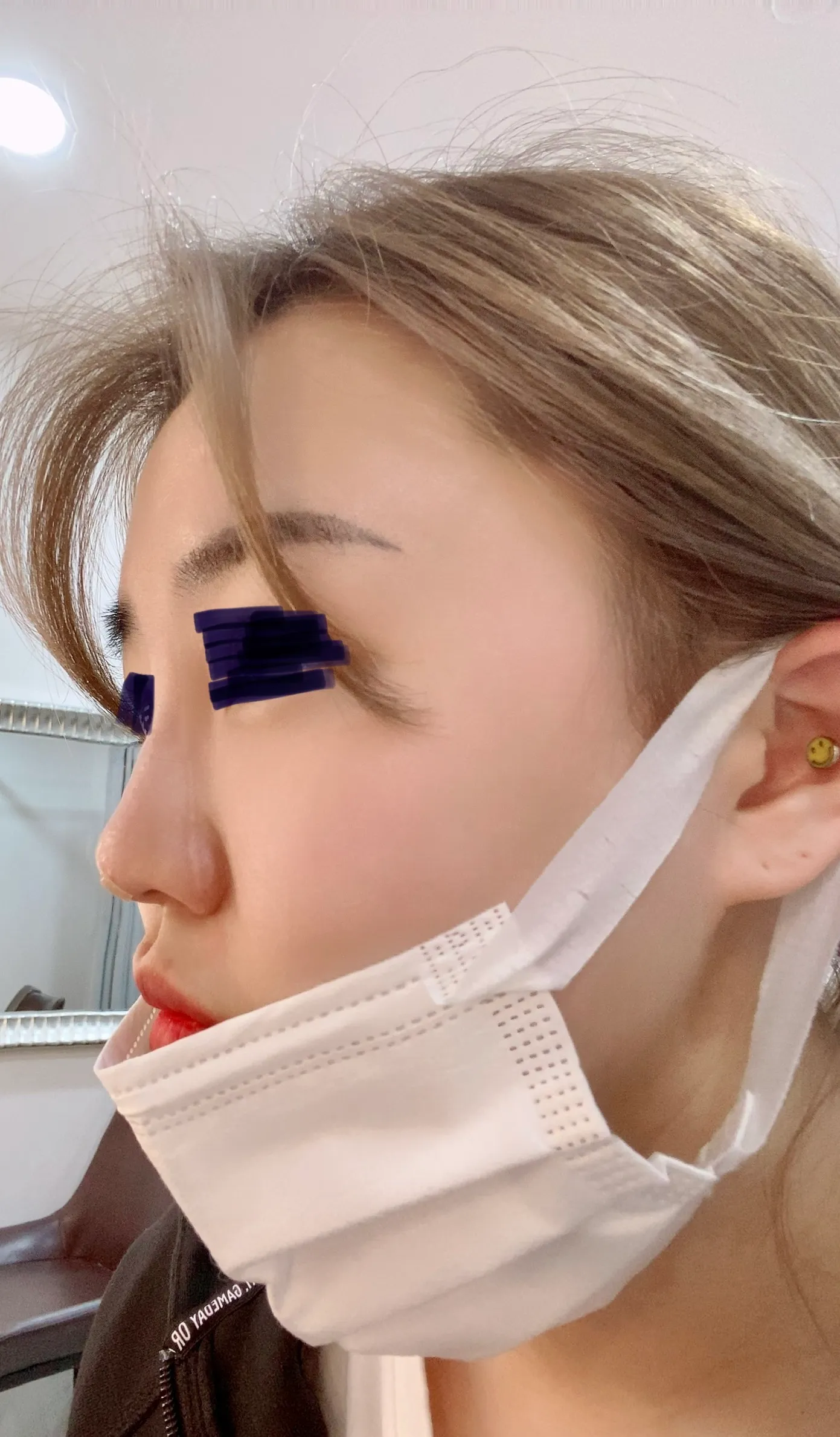 施術後 — ミケイ 自信のある鼻筋 ミント糸_ハイコ