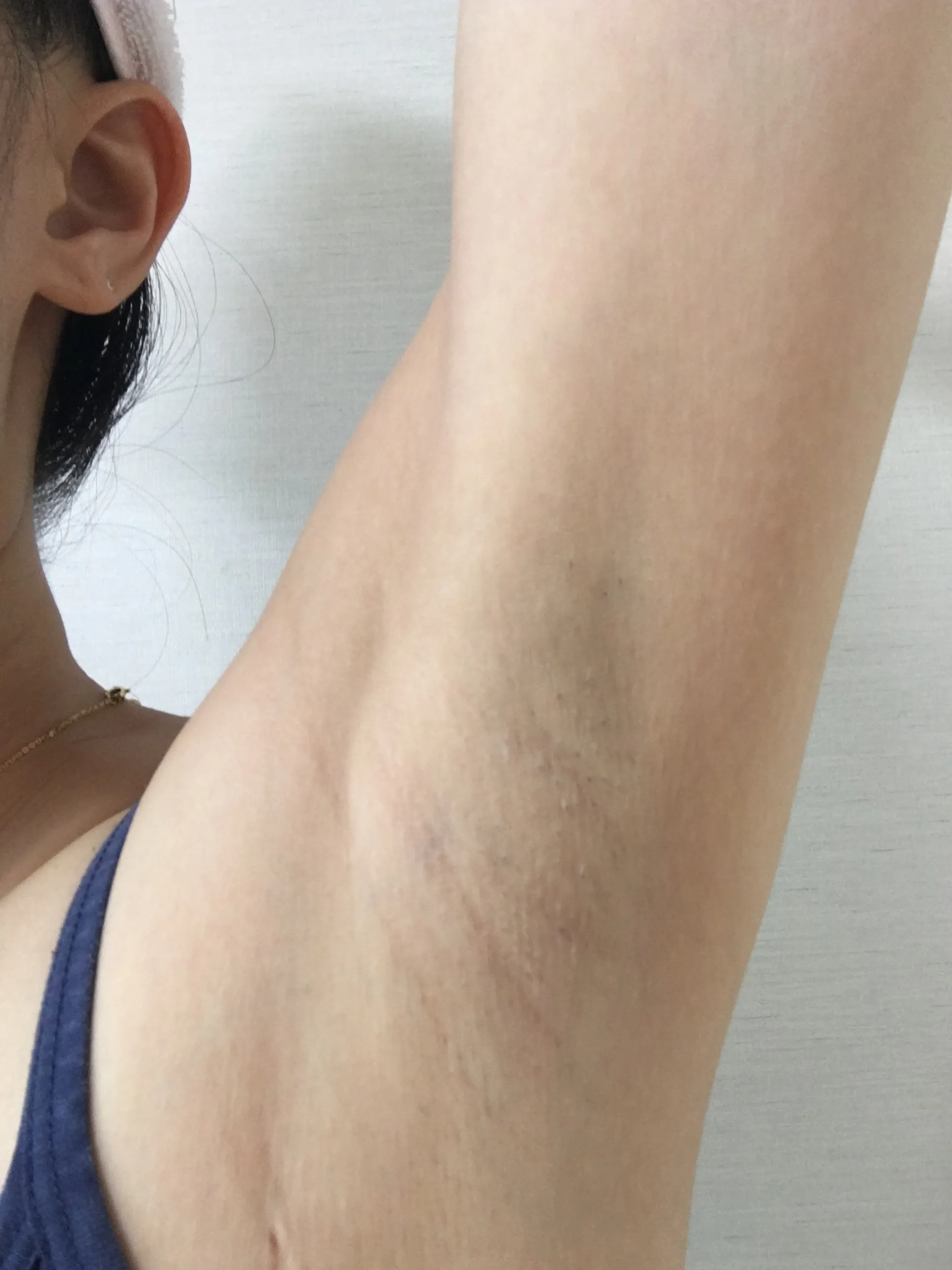 施術後 — アポジ腋毛脱毛5回 2.2万円！