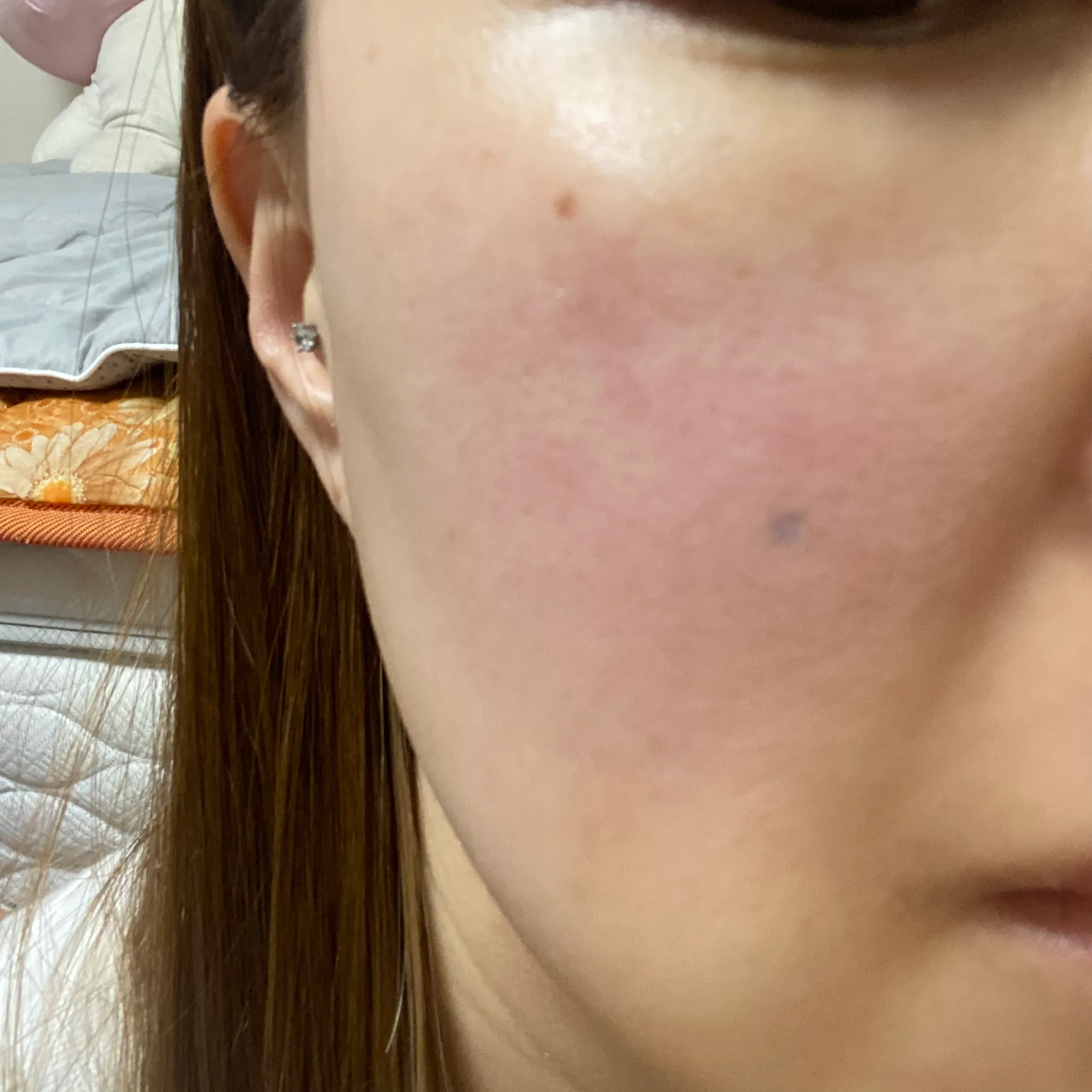 施術前 — 紅潮薬で顔面紅潮さようなら