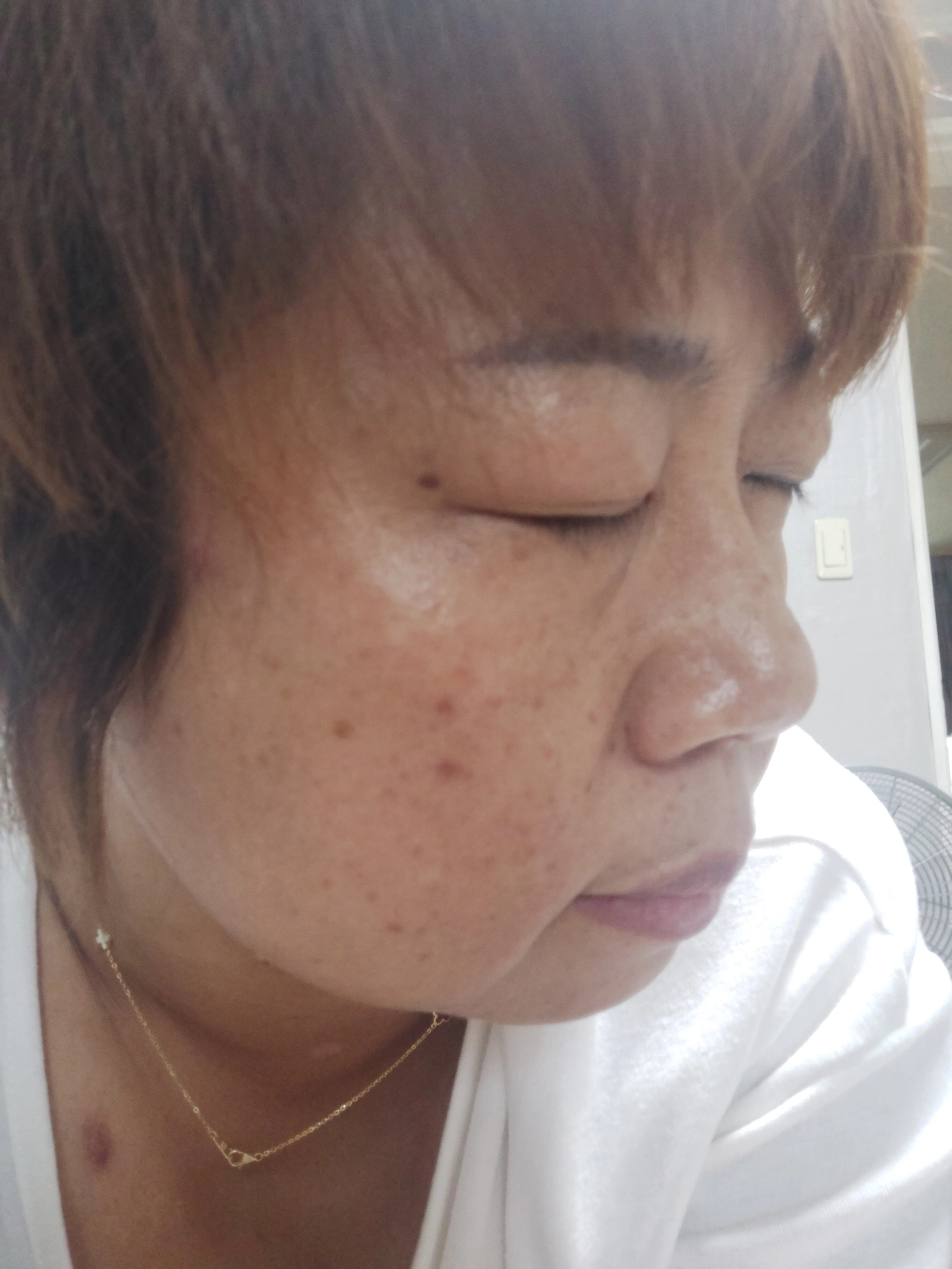 시술 전 — 기미/색소 완벽파괴! #대세 피코토닝