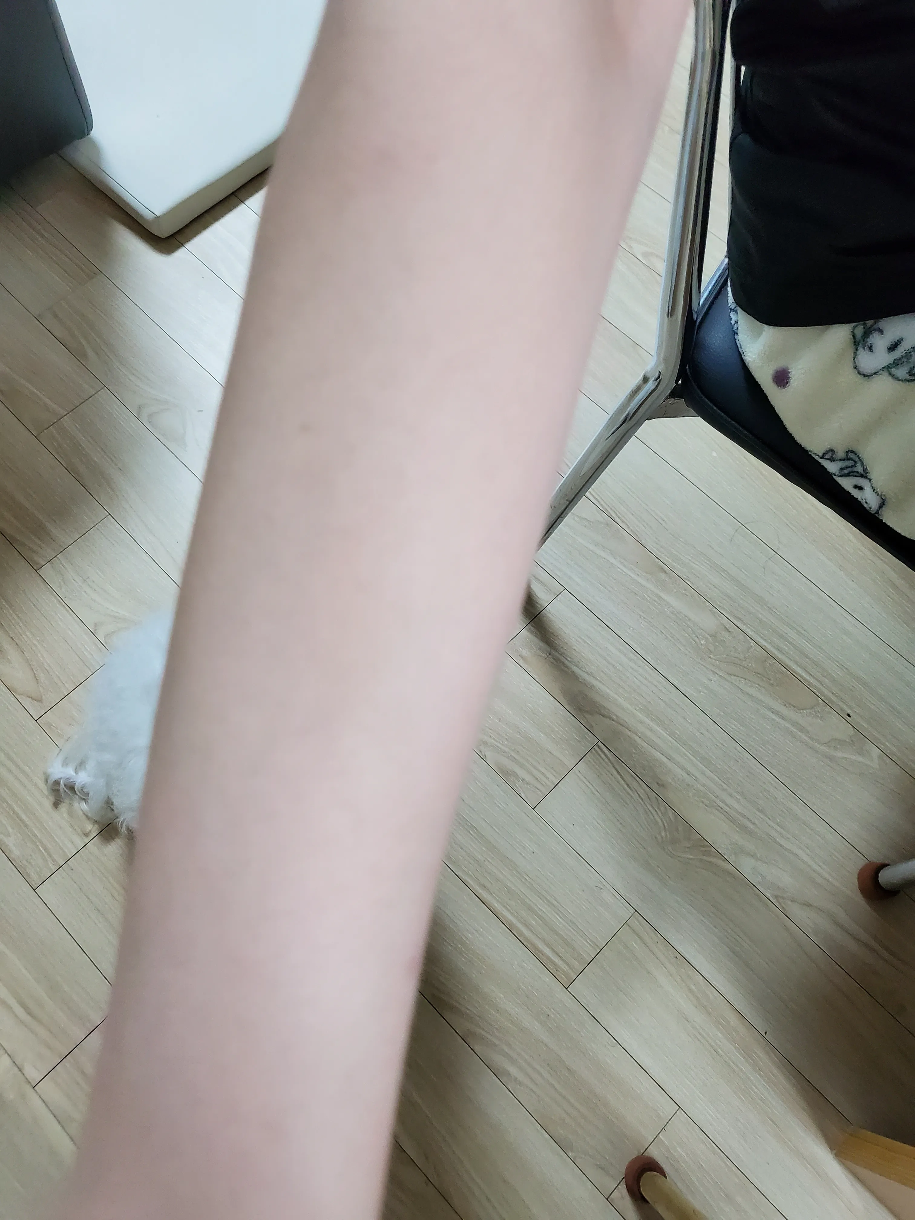 시술 후 — 클라리티 아이스 레이저 제모