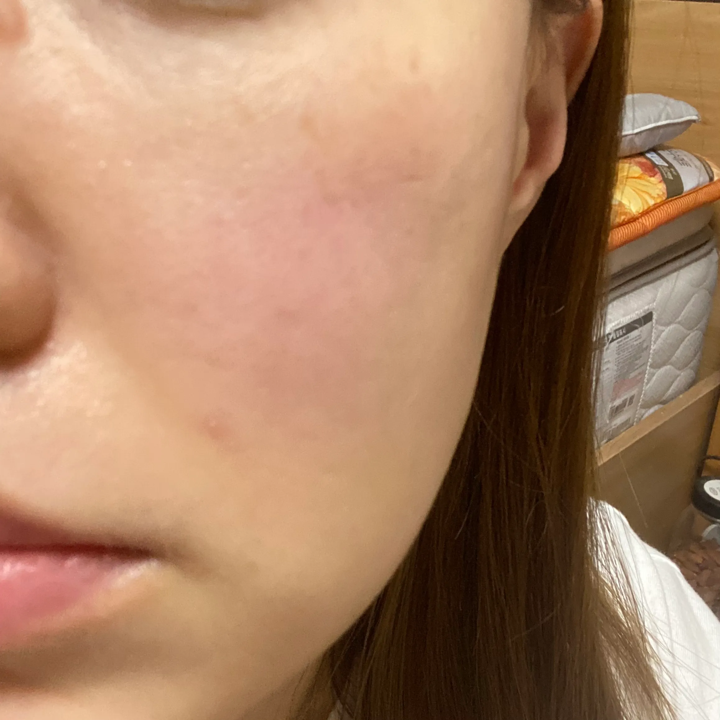 施術後 — 紅潮薬で顔面紅潮さようなら