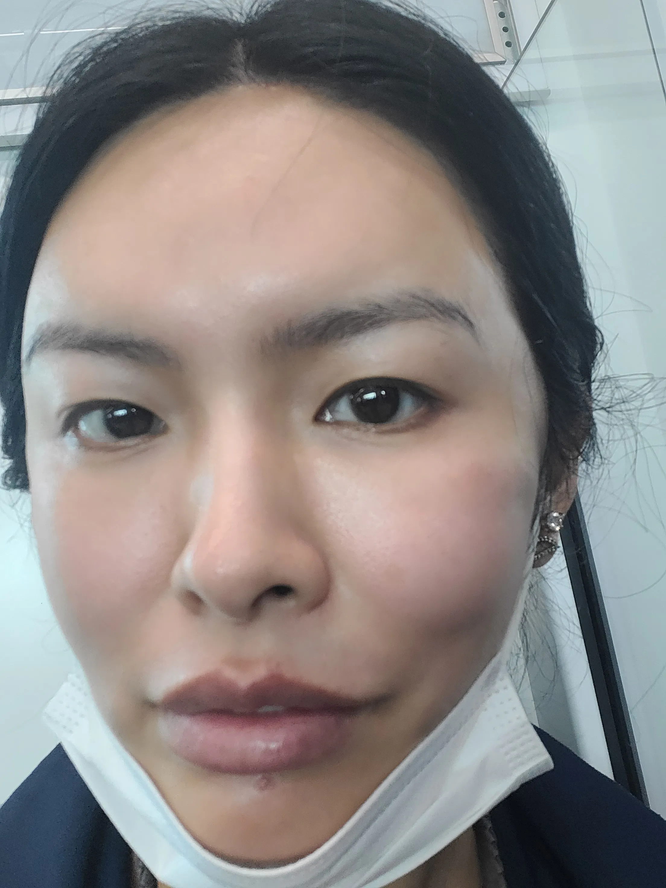 시술 후 — [잡티지우개]에이톤레이저
