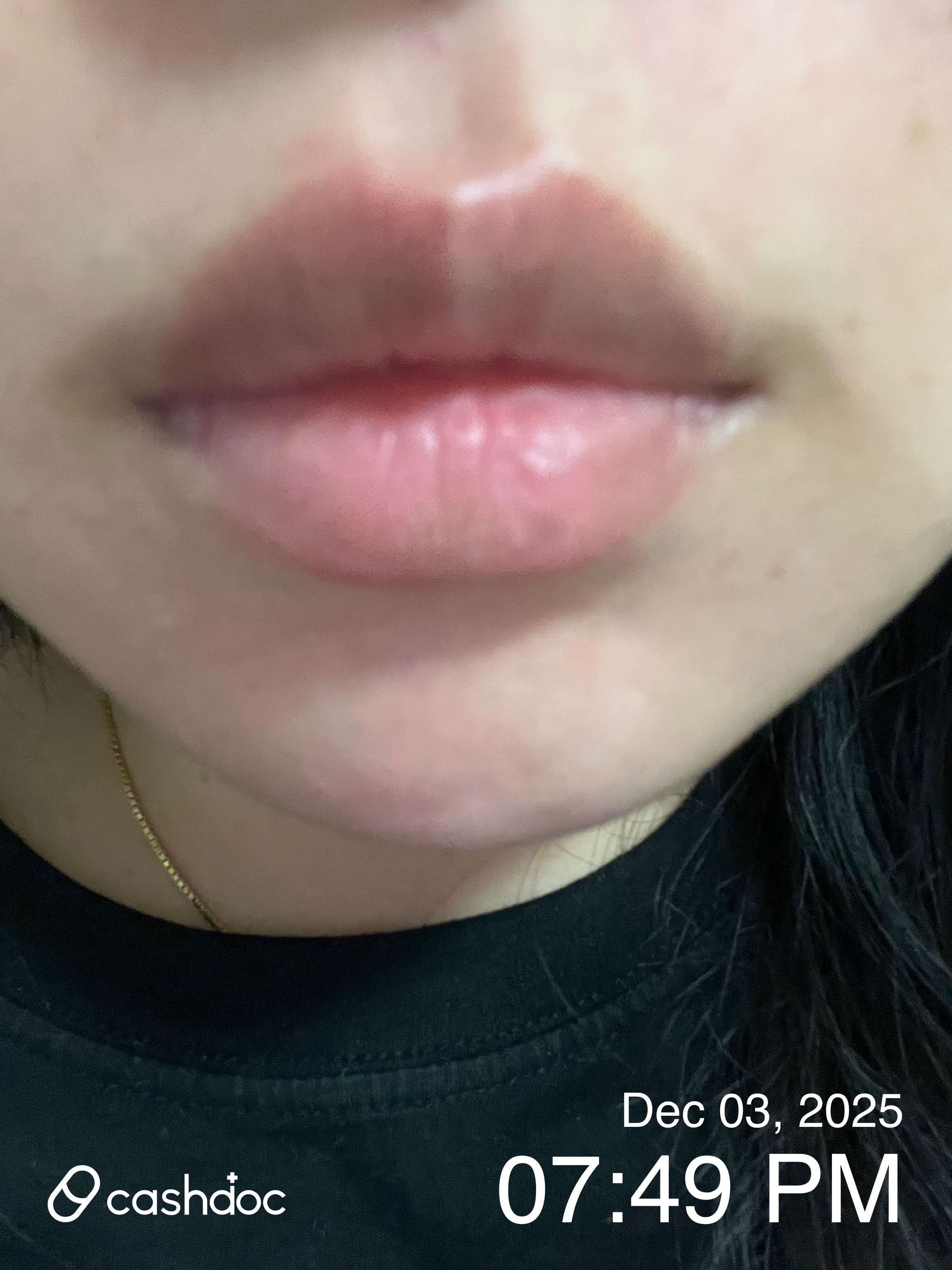 충청북도 하얀드림피부과의원에서 입술 헤르페스 치료 후기: 진료 대기시간 짧고 효과적인 처방 경험