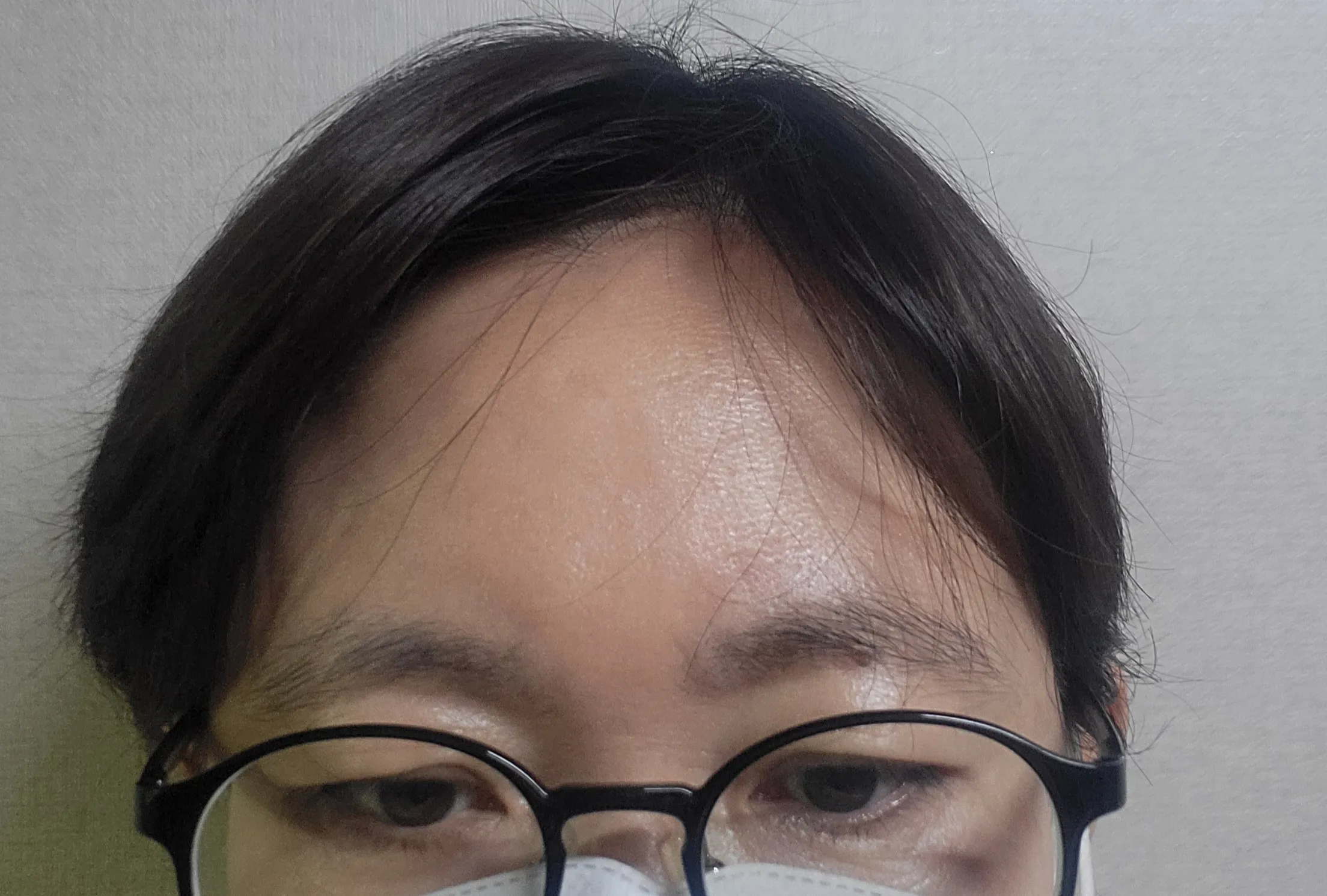시술 전 — 	번지지않는 아이라인반영구	