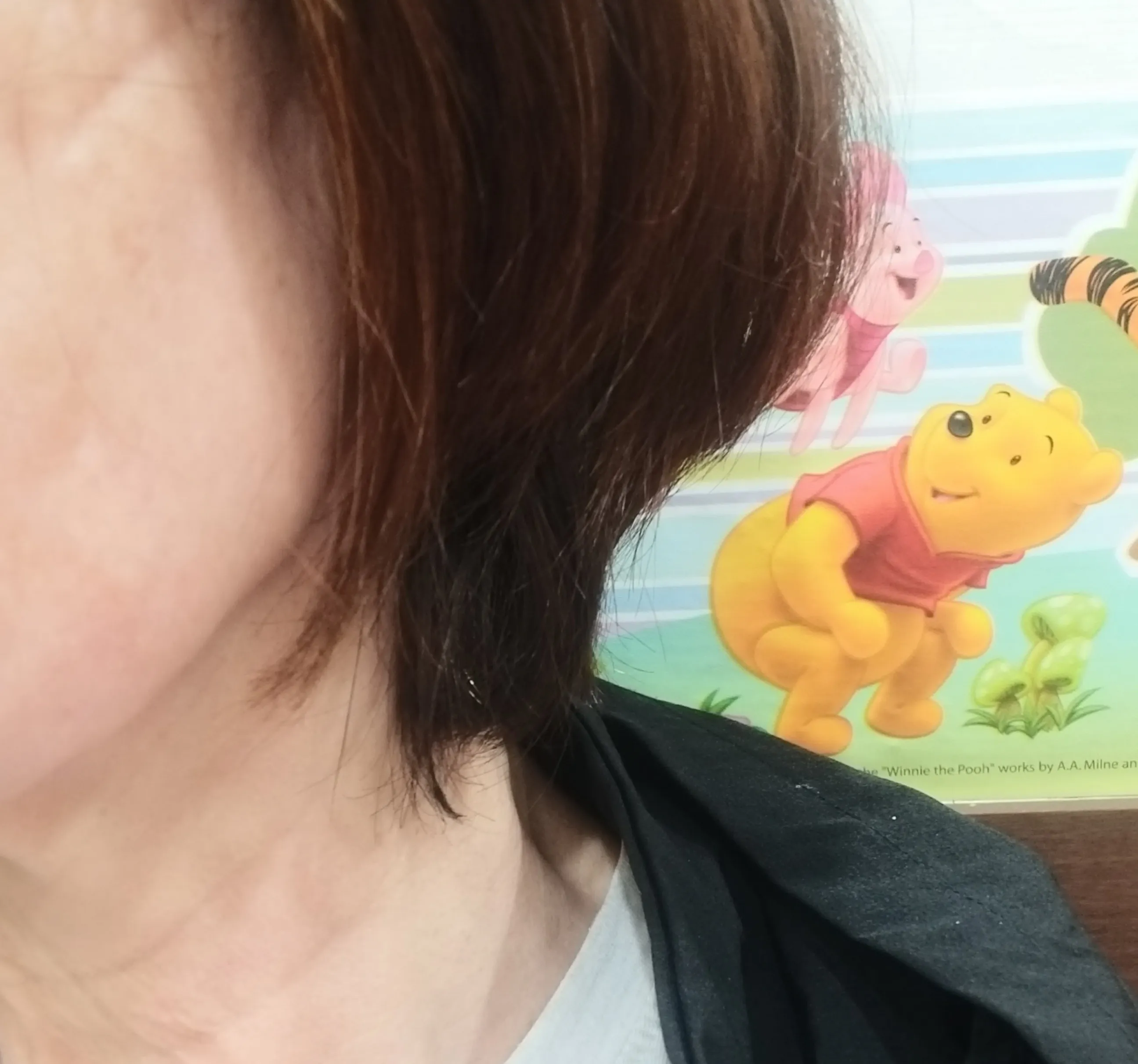 시술 전 — 레이저토닝