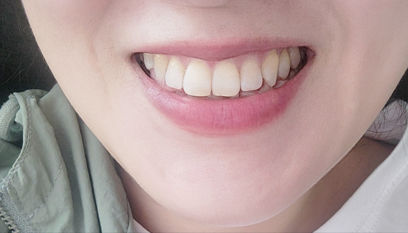 북구 뉴드림치과의원에서 시린치아 레진 치료 후기